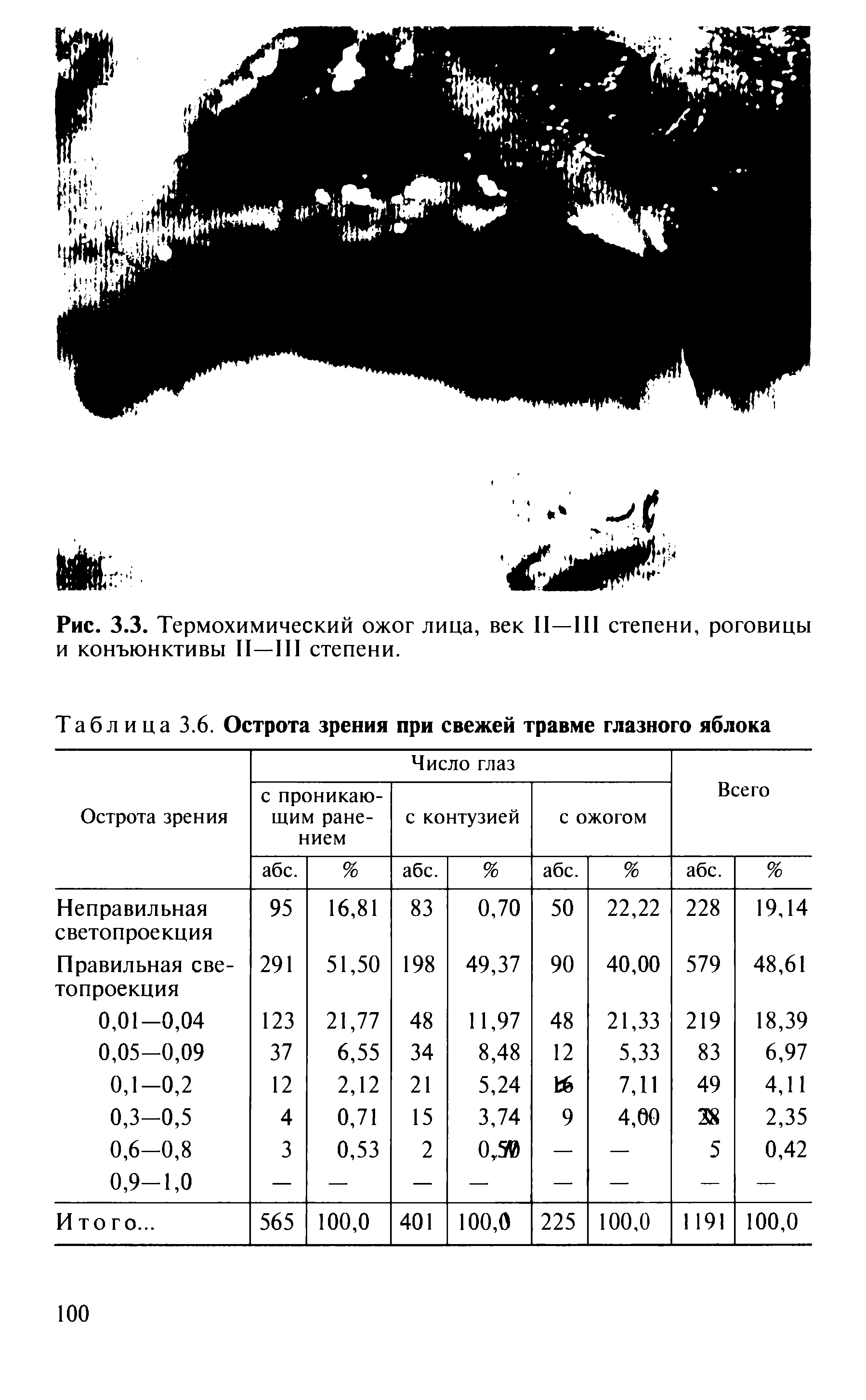 Таблица 3.6. Острота зрения при свежей травме глазного яблока...