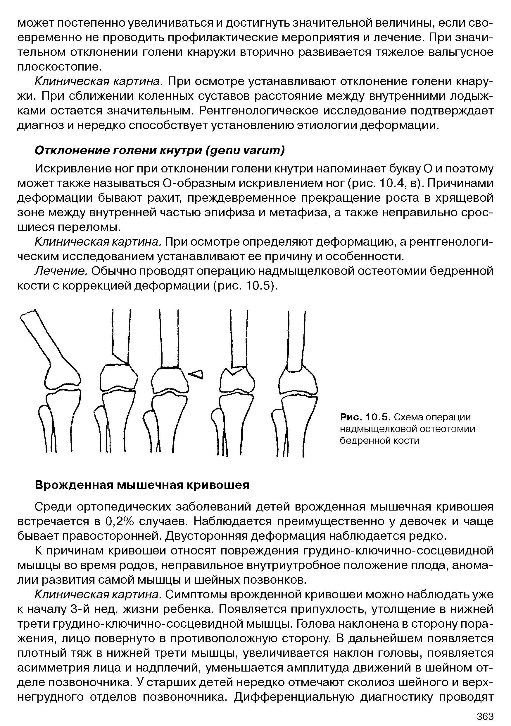 Рис. 10.5. Схема операции надмыщелковой остеотомии бедренной кости...