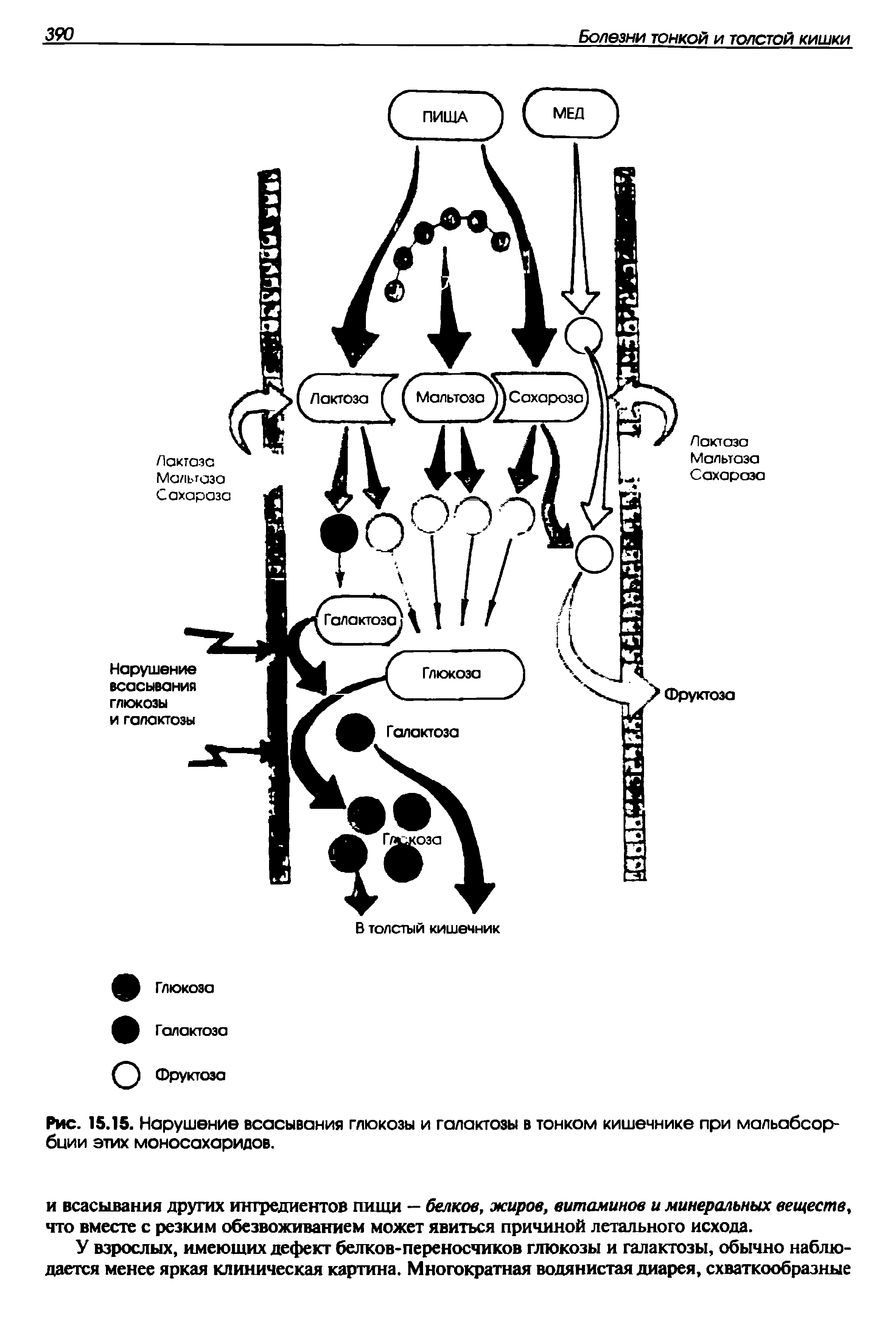 Рис. 15.15. Нарушение всасывания глюкозы и галактозы в тонком кишечнике при мальабсорбции этих моносахаридов.