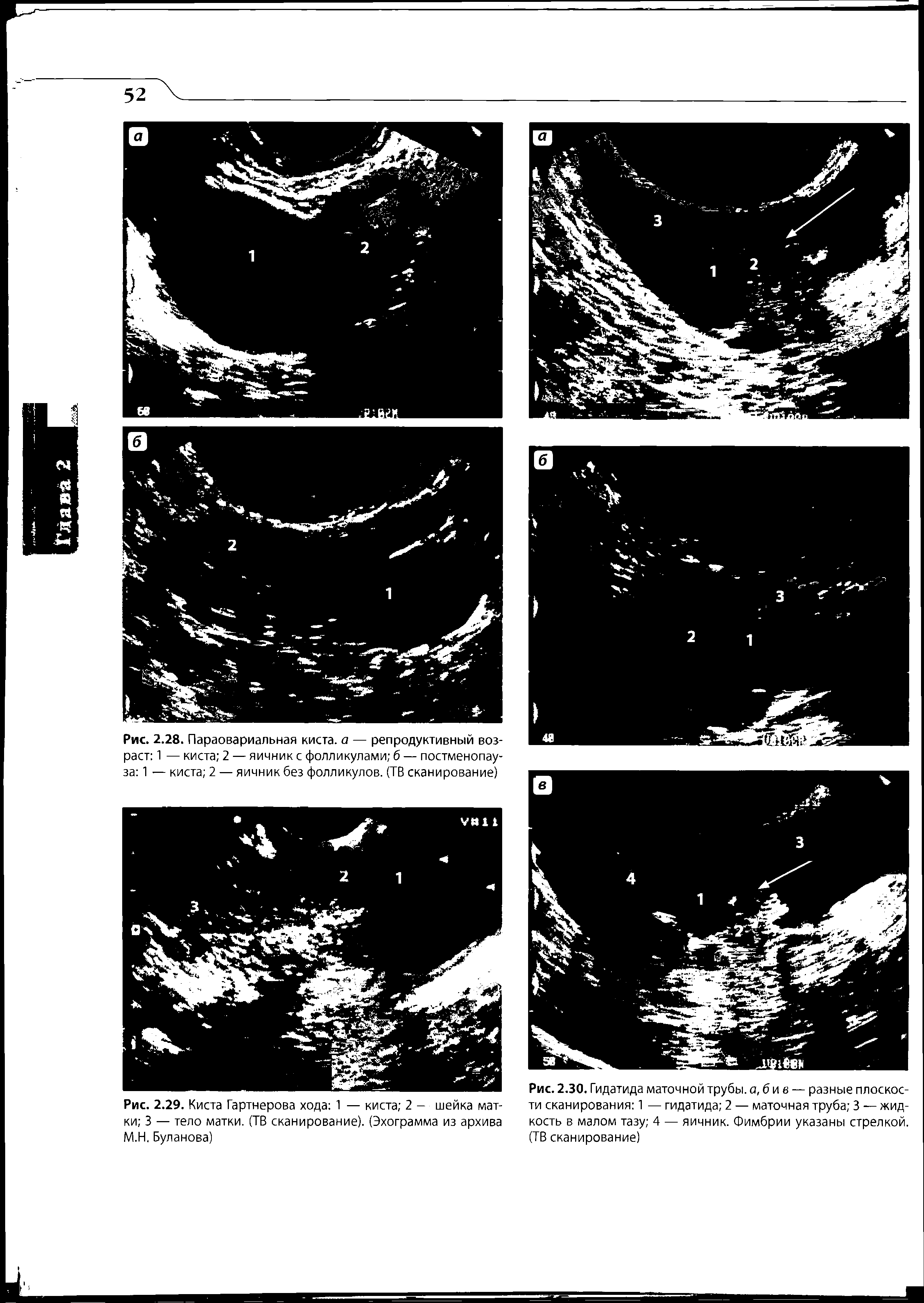 Рис. 2.28. Параовариальная киста, а — репродуктивный возраст 1 — киста 2 — яичник с фолликулами б — постменопауза 1 — киста 2 — яичник без фолликулов. (ТВ сканирование)...