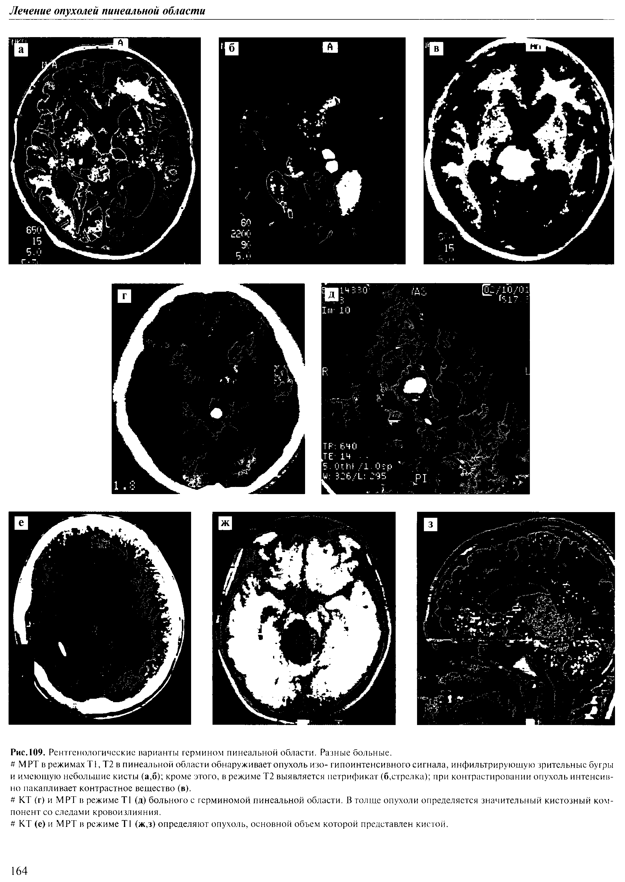 Рис. 109. Рентгенологические варианты гермином пинеальной области. Разные больные.