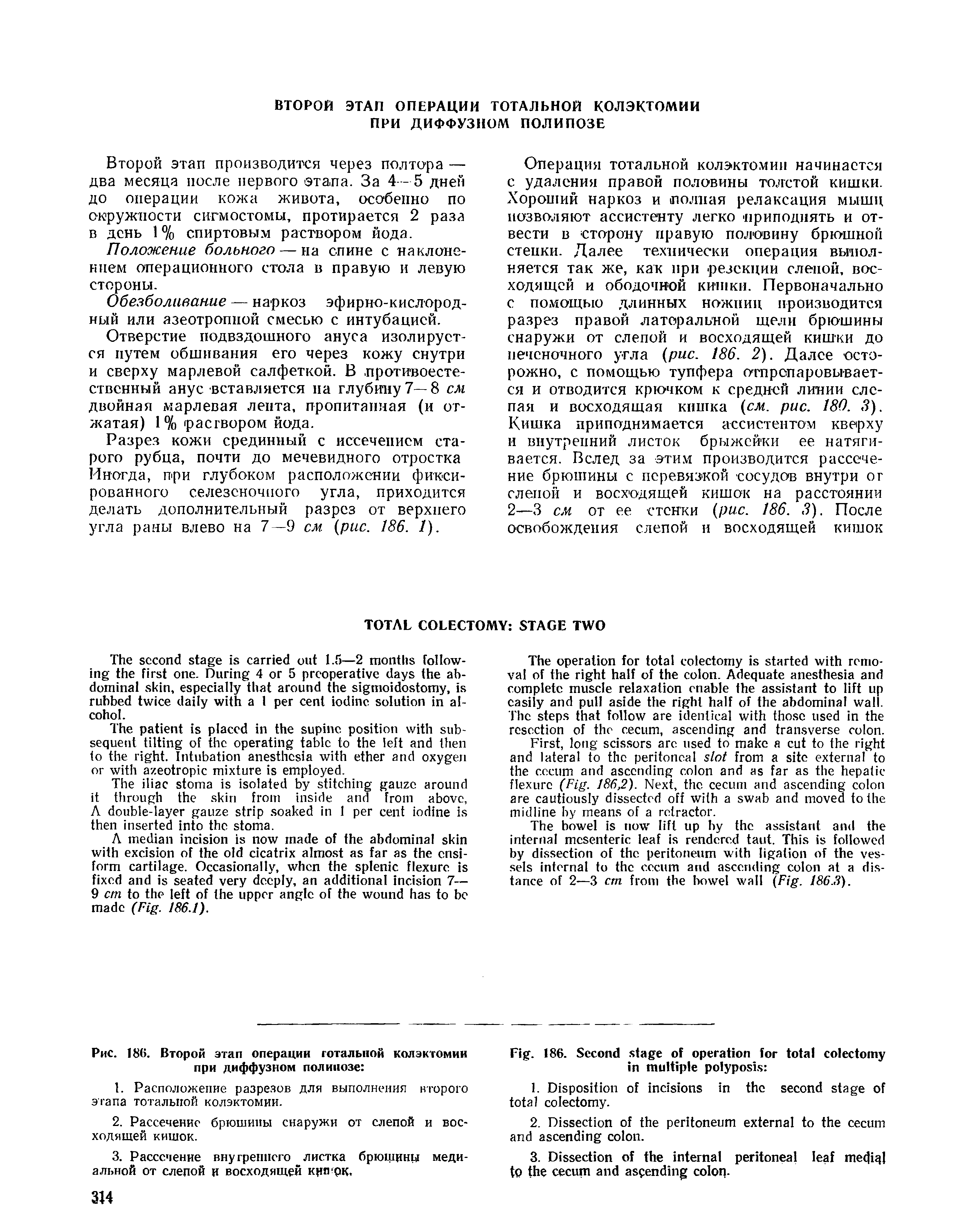 Рис. 186. Второй этап операции тотальной колэктомии при диффузном полипозе ...