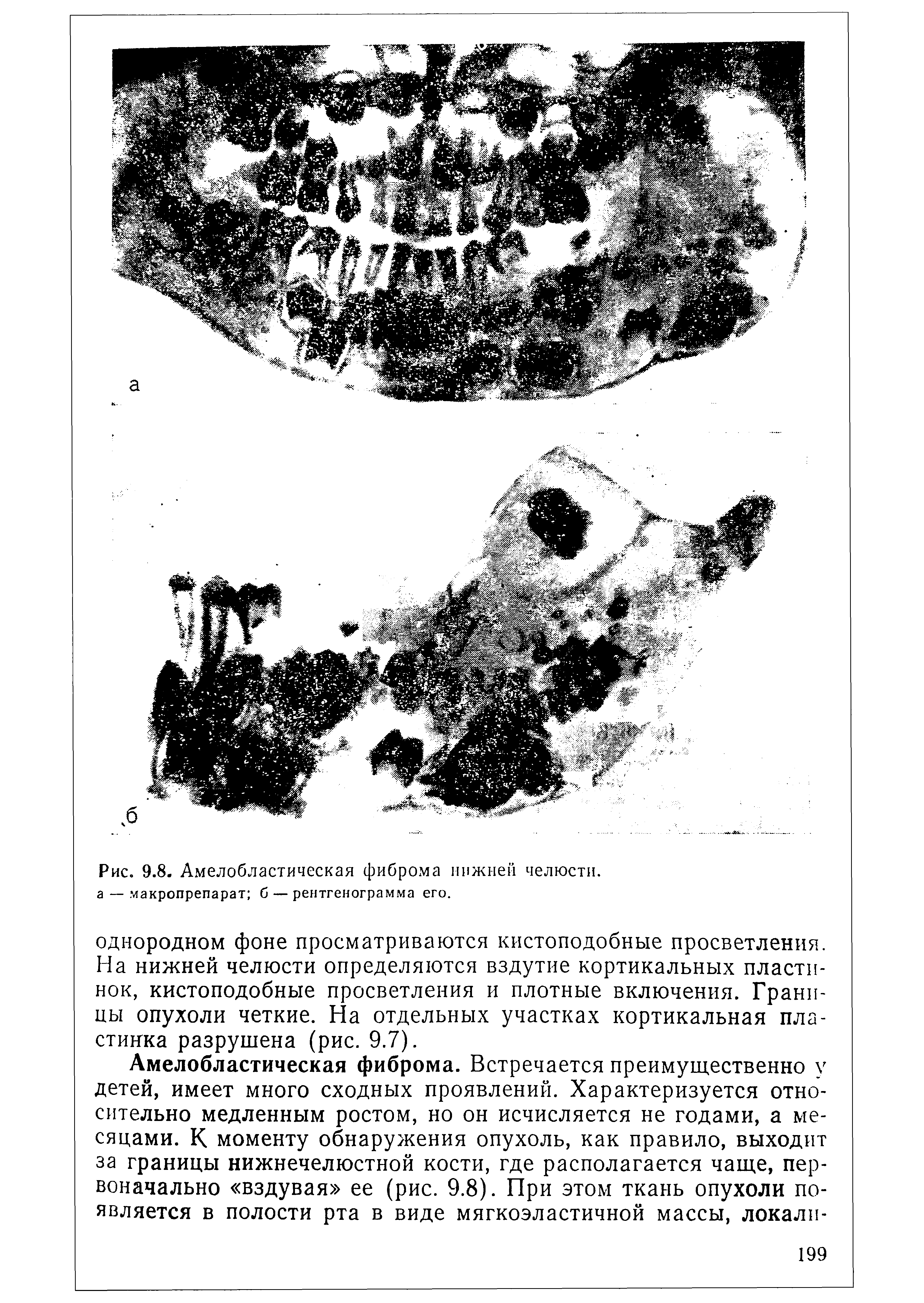 Рис. 9.8. Амелобластическая фиброма нижней челюсти, а — макропрепарат б — рентгенограмма его.