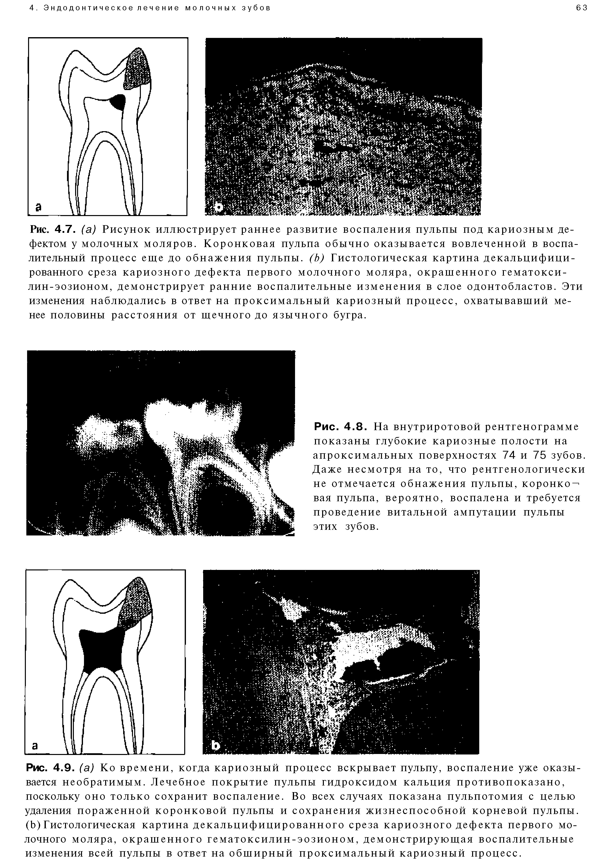 Рис. 4.8. На внутриротовой рентгенограмме показаны глубокие кариозные полости на апроксимальных поверхностях 74 и 75 зубов. Даже несмотря на то, что рентгенологически не отмечается обнажения пульпы, коронко вая пульпа, вероятно, воспалена и требуется проведение витальной ампутации пульпы этих зубов.