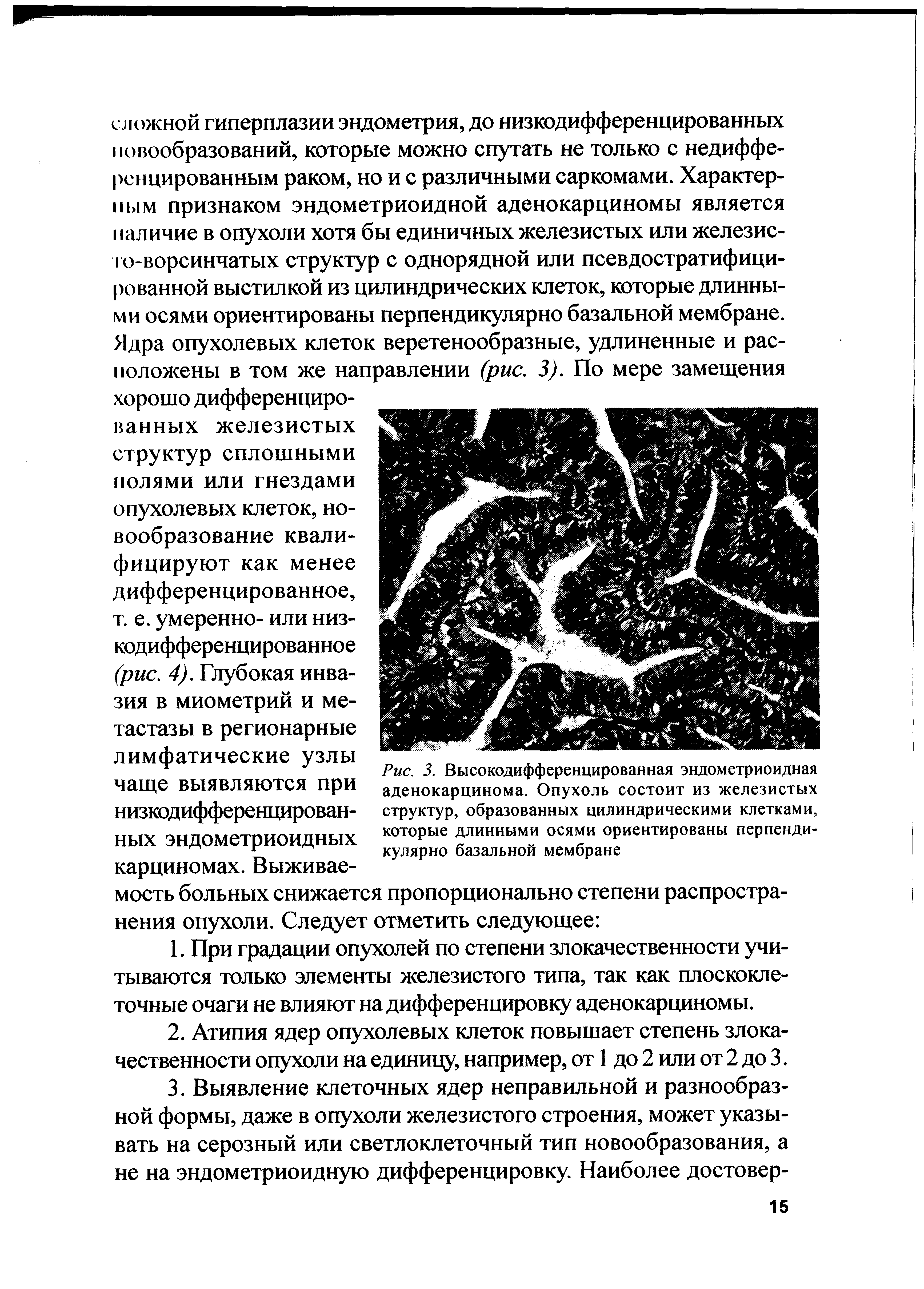 Рис. 3. Высокодифференцированная эндометриоидная аденокарцинома. Опухоль состоит из железистых структур, образованных цилиндрическими клетками, которые длинными осями ориентированы перпендикулярно базальной мембране...