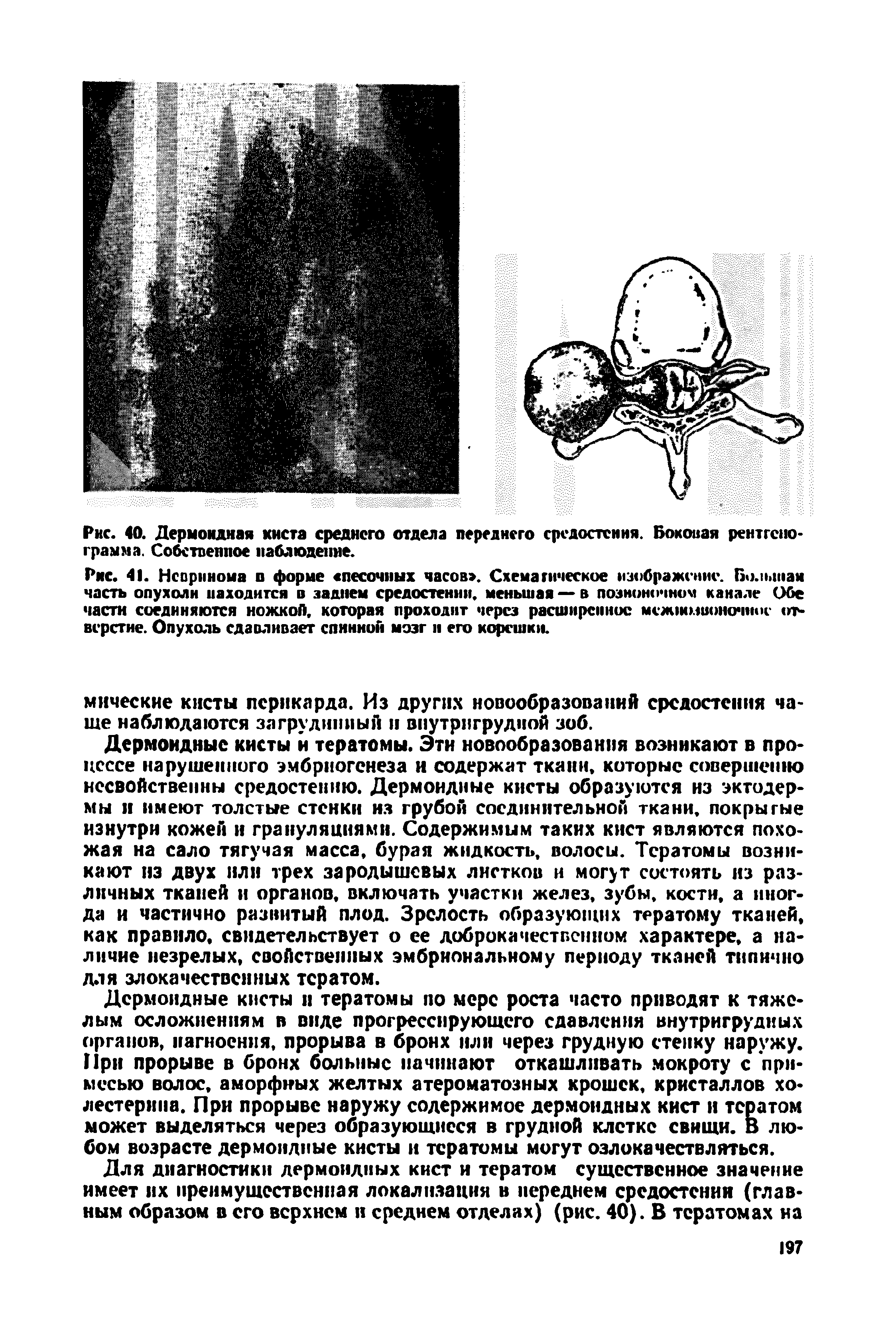 Рис. 41. Невринома о форме песочных часов . Схематическое изображение. Бо.и>шая часть опухоли находится в заднем средостении, меньшая — в полномочном канале Обе части соединяются ножкой. которая проходит через расширенное мсжшмионочиос отверстие. Опухоль сдавливает спинной мозг и его корешки.