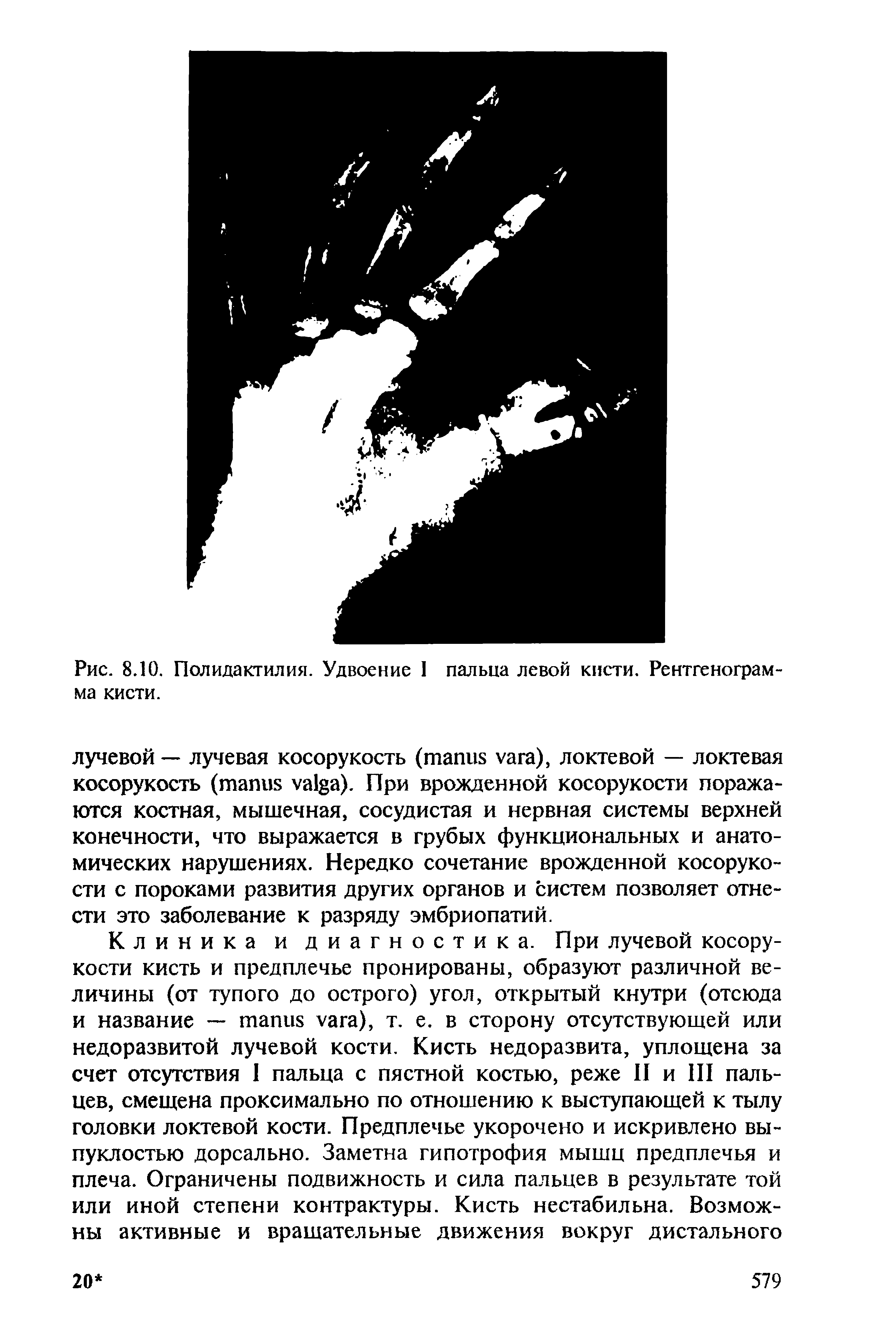 Рис. 8.10. Полидактилия. Удвоение I пальца левой кисти. Рентгенограмма кисти.