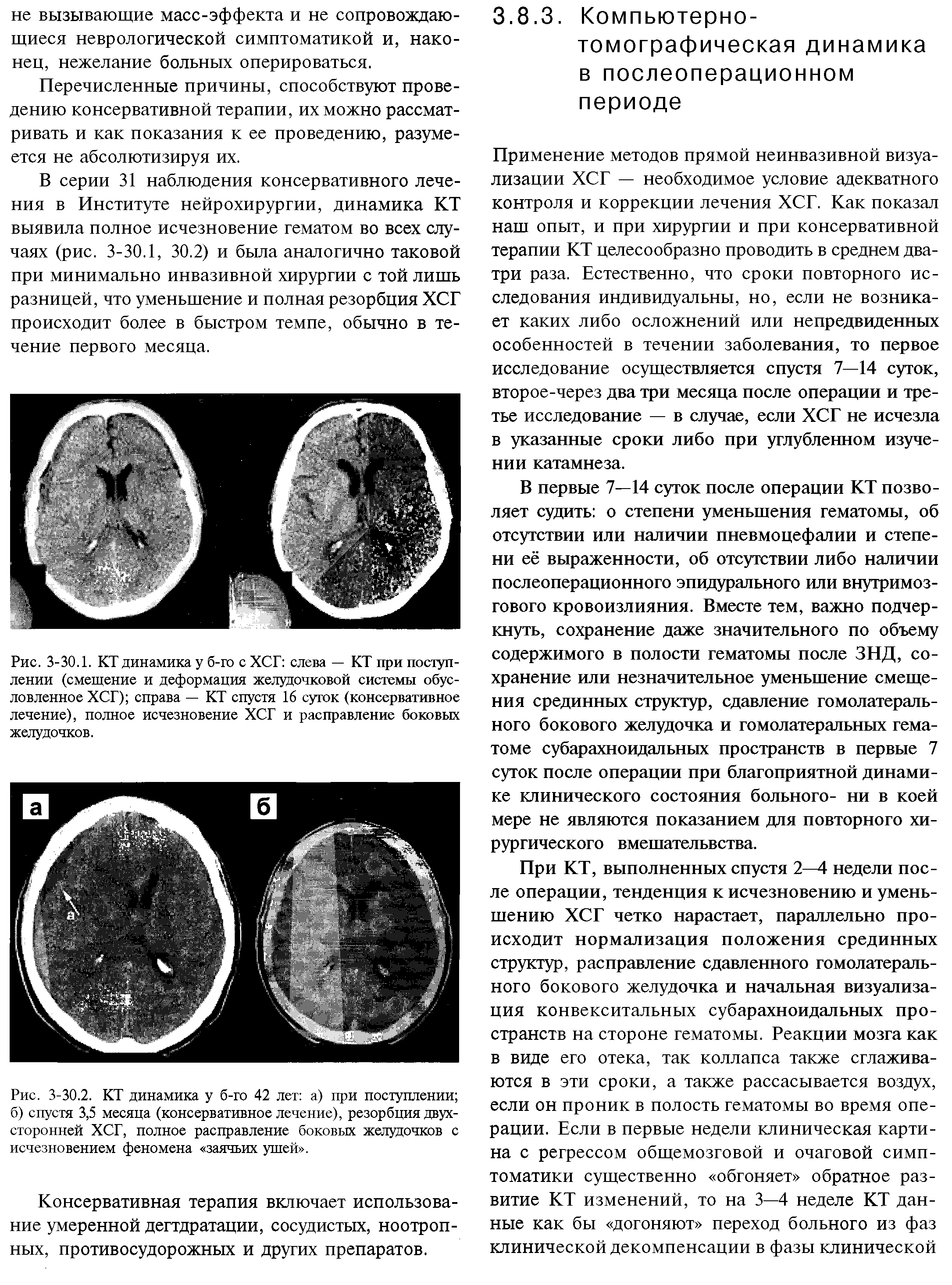 Рис. 3-30.1. КТ динамика у б-го с ХСГ слева — КТ при поступлении (смещение и деформация желудочковой системы обусловленное ХСГ) справа — КТ спустя 16 суток (консервативное лечение), полное исчезновение ХСГ и расправление боковых желудочков.