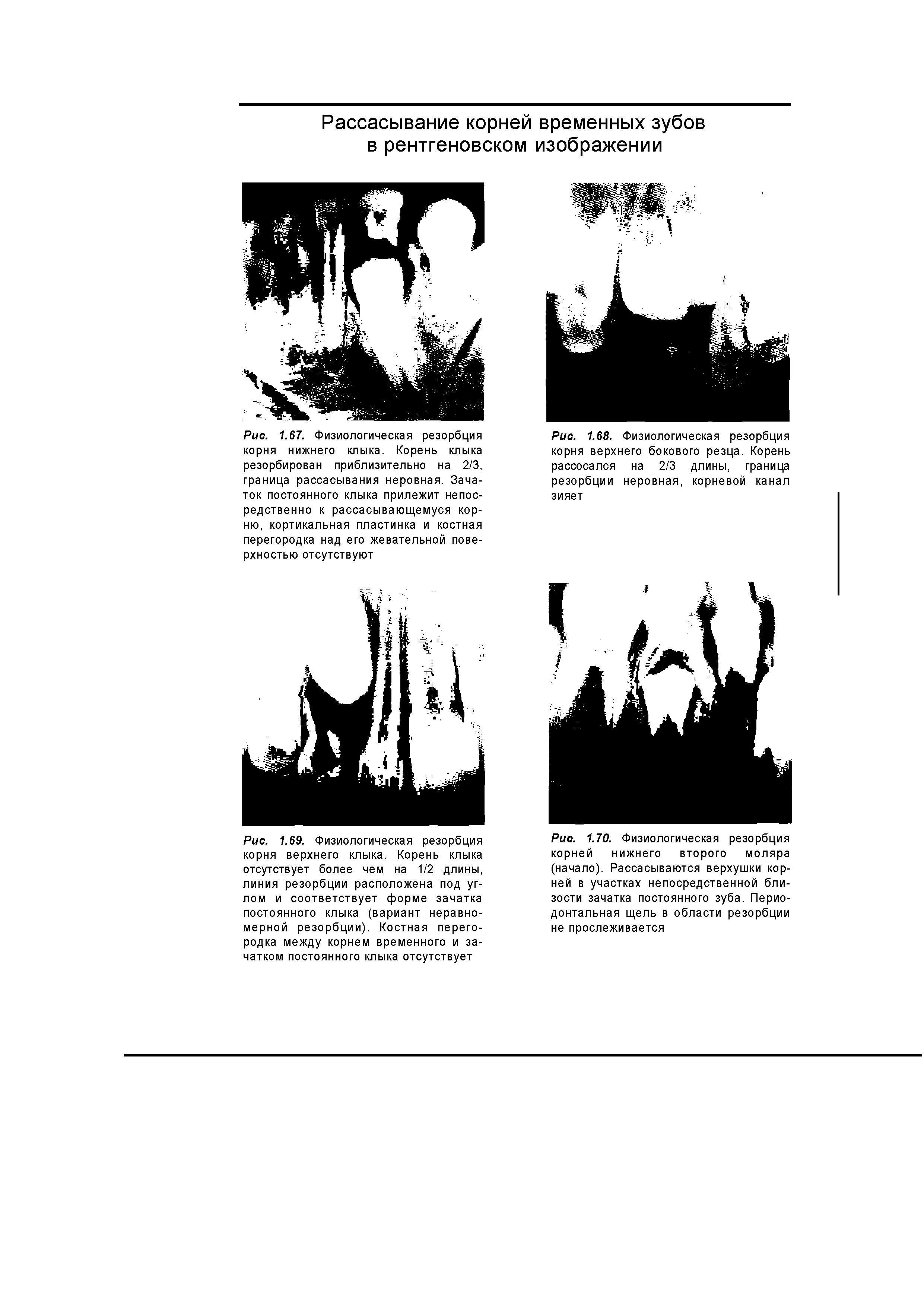 Рис. 1.67. Физиологическая резорбция корня нижнего клыка. Корень клыка резорбирован приблизительно на 2/3, граница рассасывания неровная. Зачаток постоянного клыка прилежит непосредственно к рассасывающемуся корню, кортикальная пластинка и костная перегородка над его жевательной поверхностью отсутствуют...