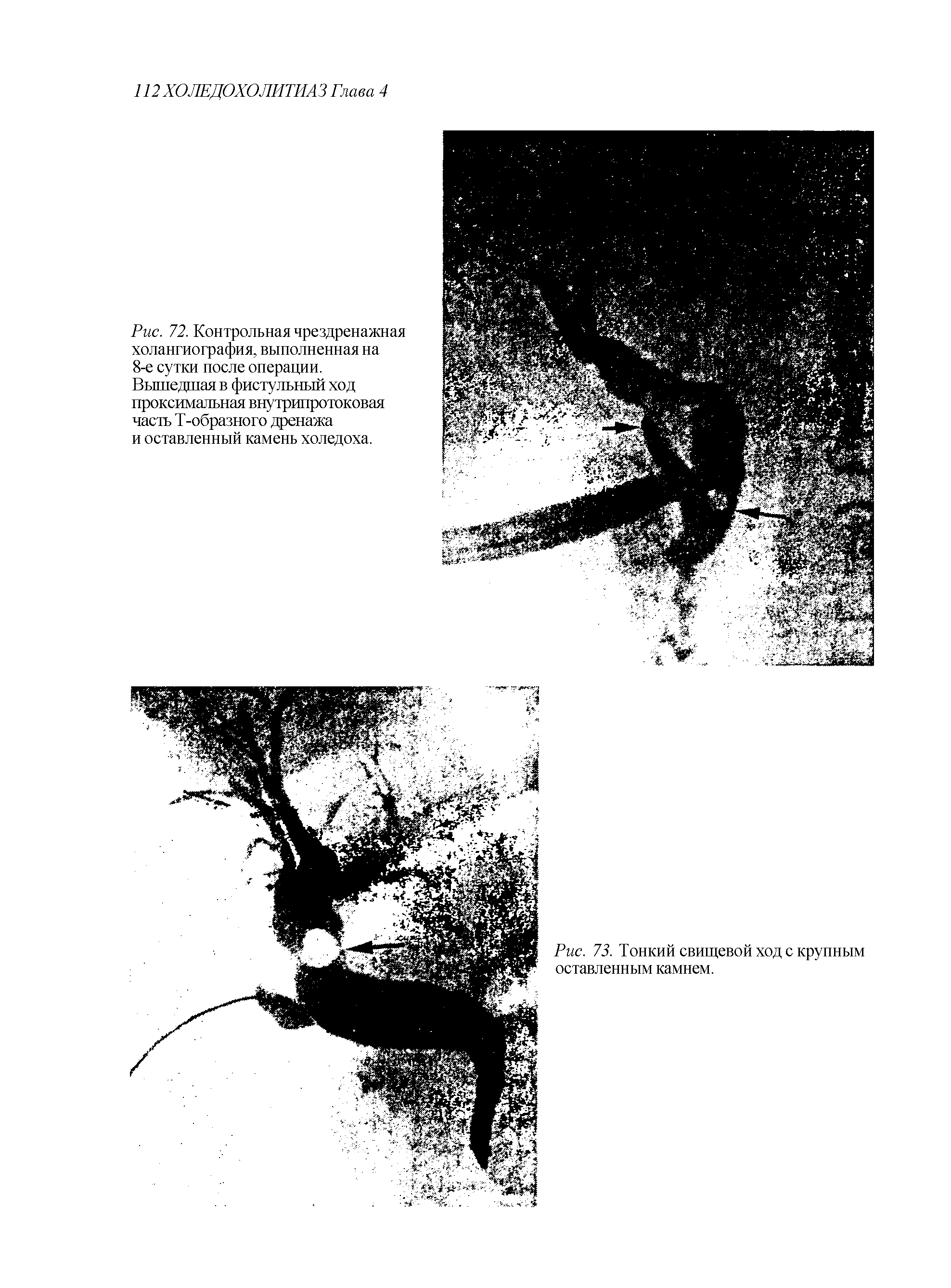 Рис. 72. Контрольная чрездренажная холангиография, выполненная на 8-е сутки после операции. Вышедшая в фистульный ход проксимальная внутрипротоковая часть Т-образного дренажа и оставленный камень холедоха.