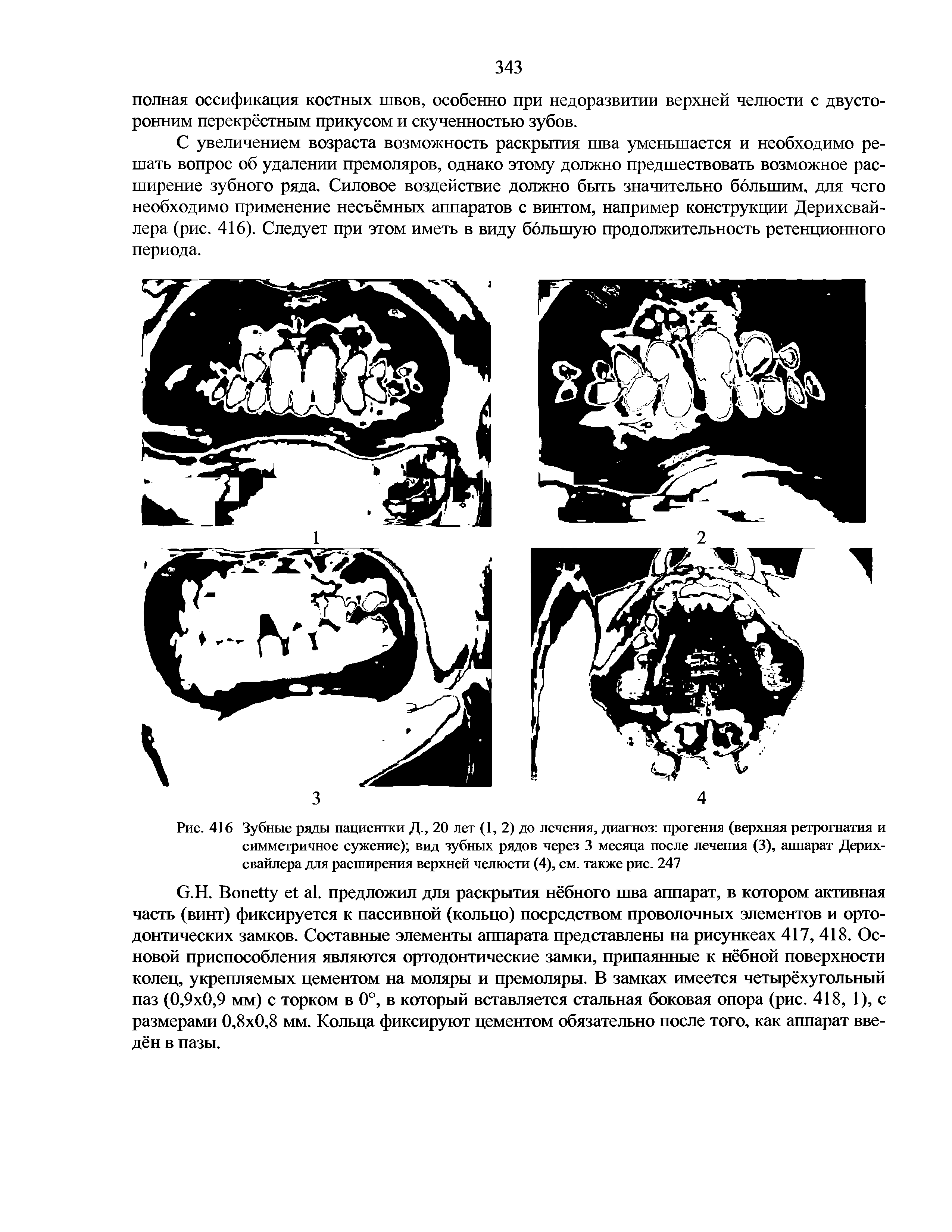 Рис. 416 Зубные рады пациентки Д., 20 лет (1, 2) до лечения, диагноз прогения (верхняя ретрогнатия и симметричное сужение) вид зубных радов через 3 месяца после лечения (3), аппарат Дерих-свайлера для расширения верхней челюсти (4), см. также рис. 247...