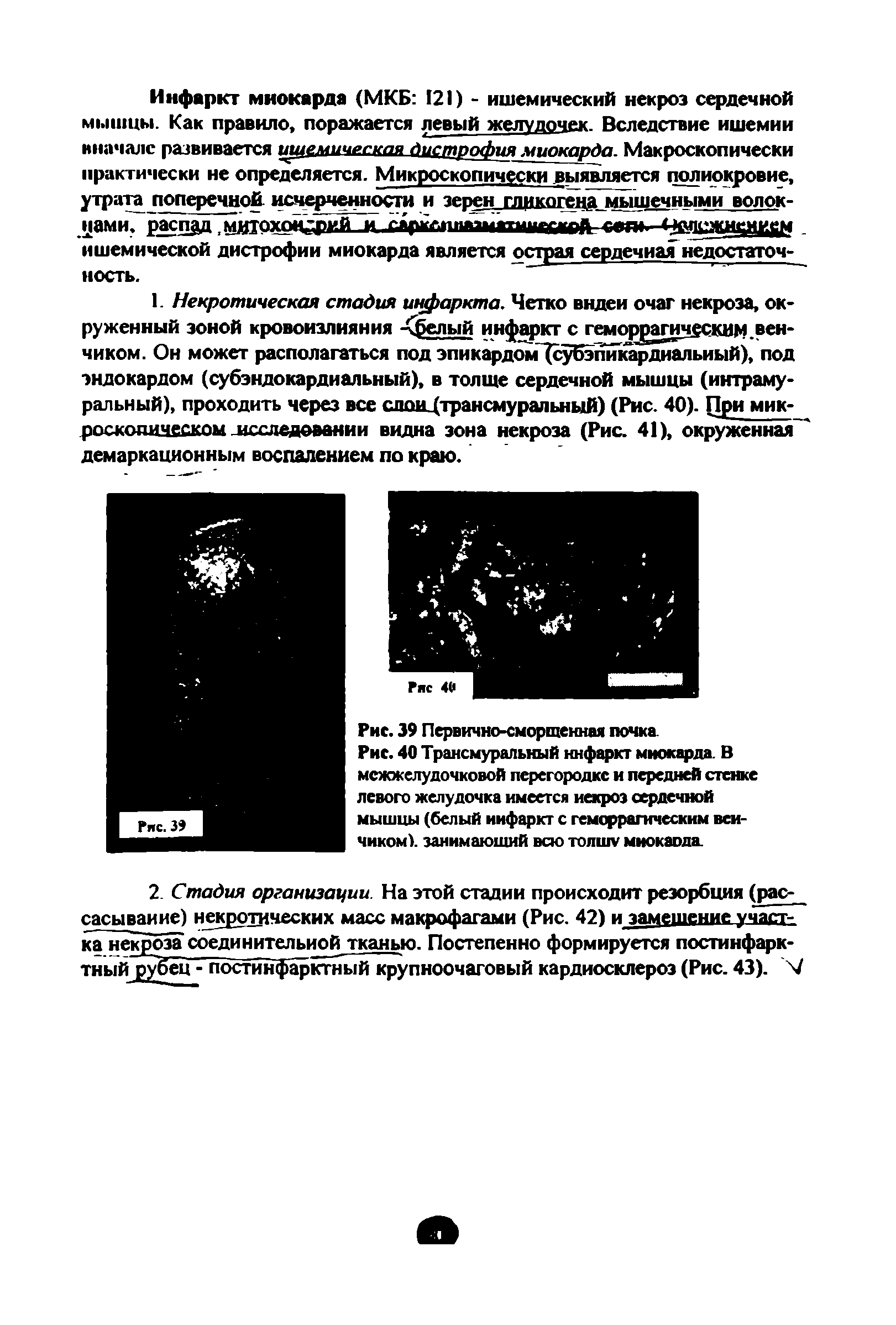 Рис. 40 Трансмуральный инфаркт миокарда. В межжелудочковой перегородке и передней стенке левого желудочка имеется некроз сердечной мышцы (белый инфаркт с геморрагическим венчиком). занимающий всю топшу миокаода...