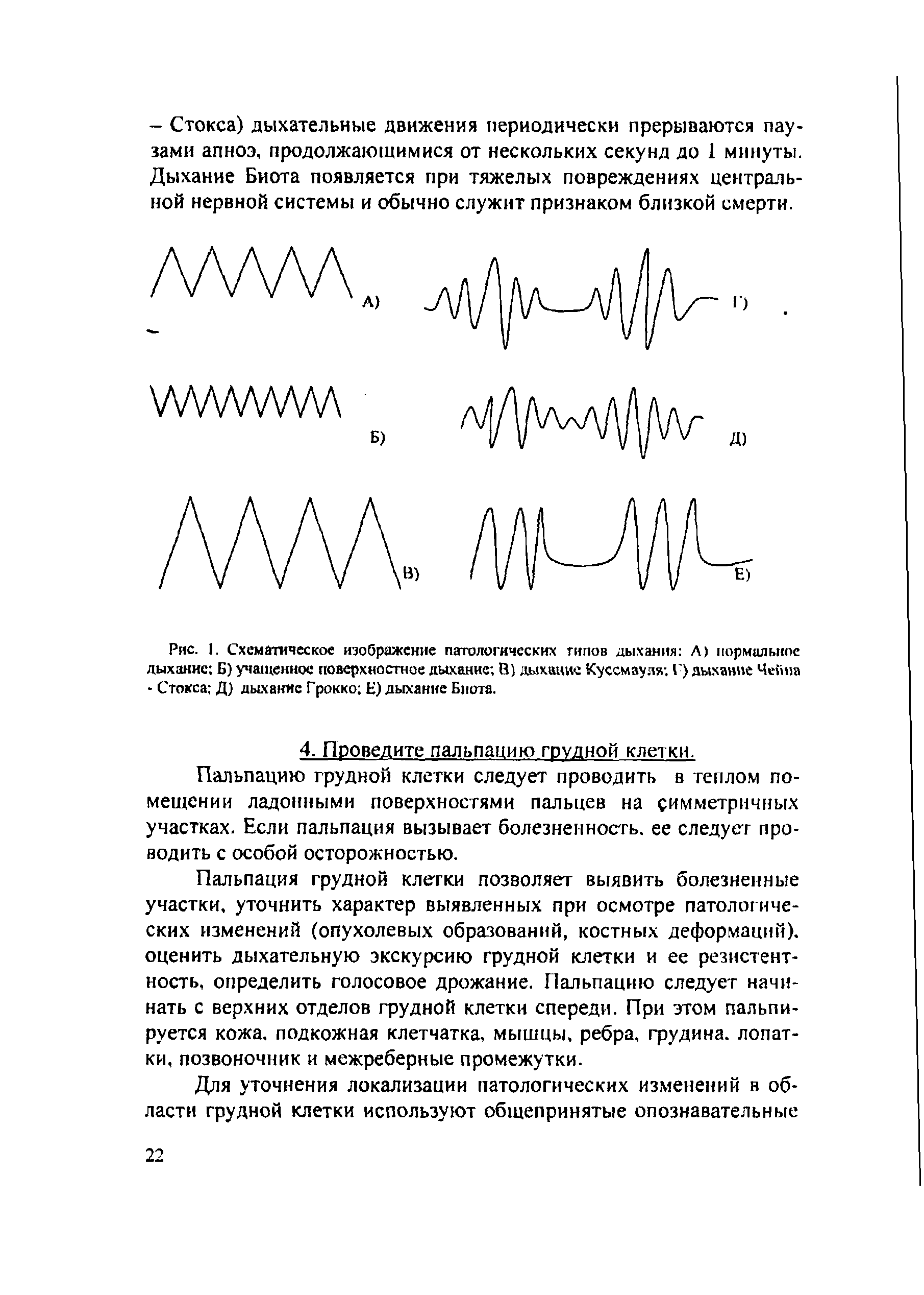 Рис. 1. Схематическое изображение патологических типов дыхания Л) нормальное дыхание Б) учащенное поверхностное дыхание В) дыхание Куссмзуля-. I ) дыхание Чейна - Стокса Д) дыхание Грокко Е) дыхание Биота.