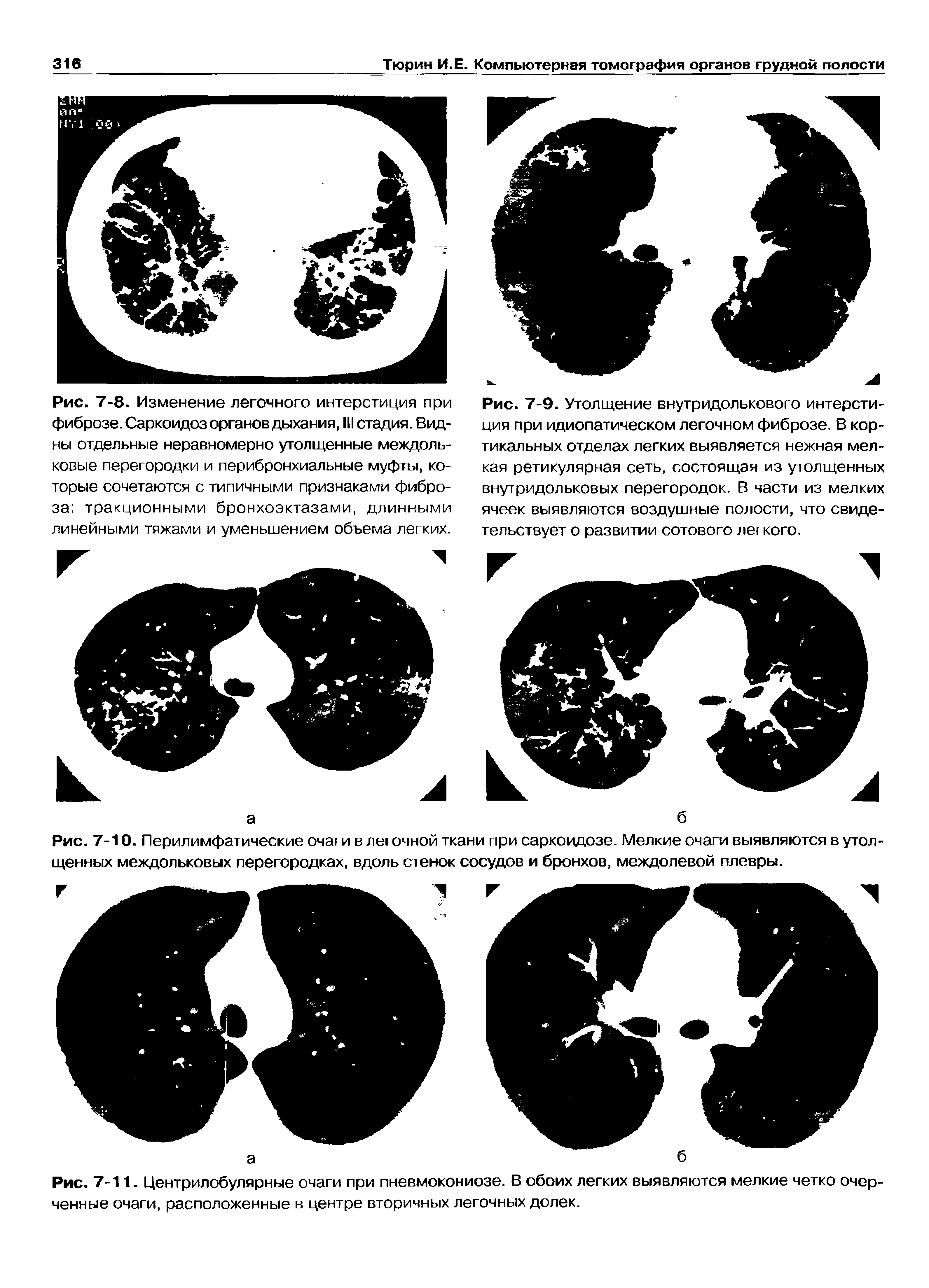 Рис. 7-10. Перилимфатические очаги в легочной ткани при саркоидозе. Мелкие очаги выявляются в утолщенных междольковых перегородках, вдоль стенок сосудов и бронхов, междолевой плевры.