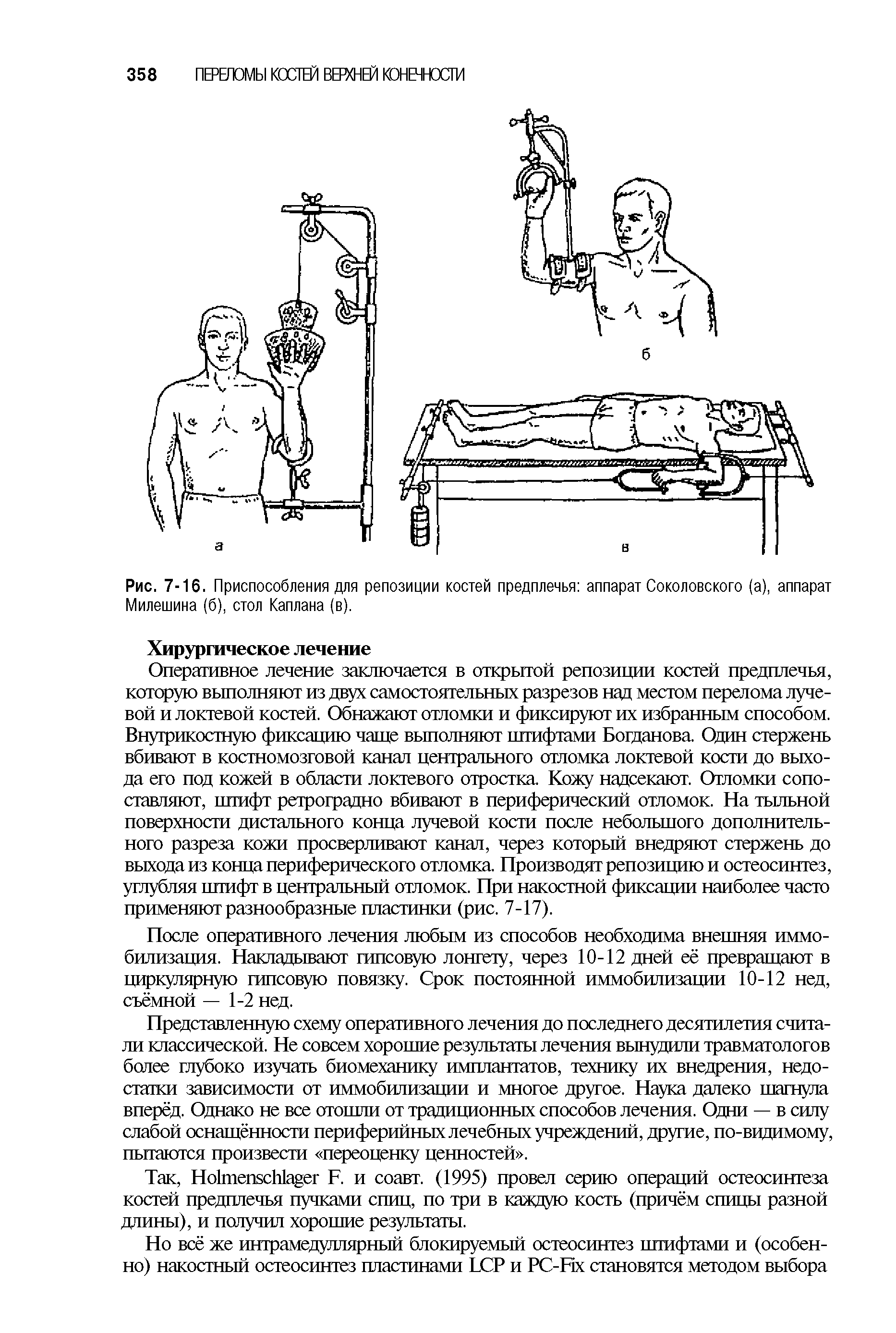 Рис. 7-16. Приспособления для репозиции костей предплечья аппарат Соколовского (а), аппарат Милешина (б), стол Каплана (в).