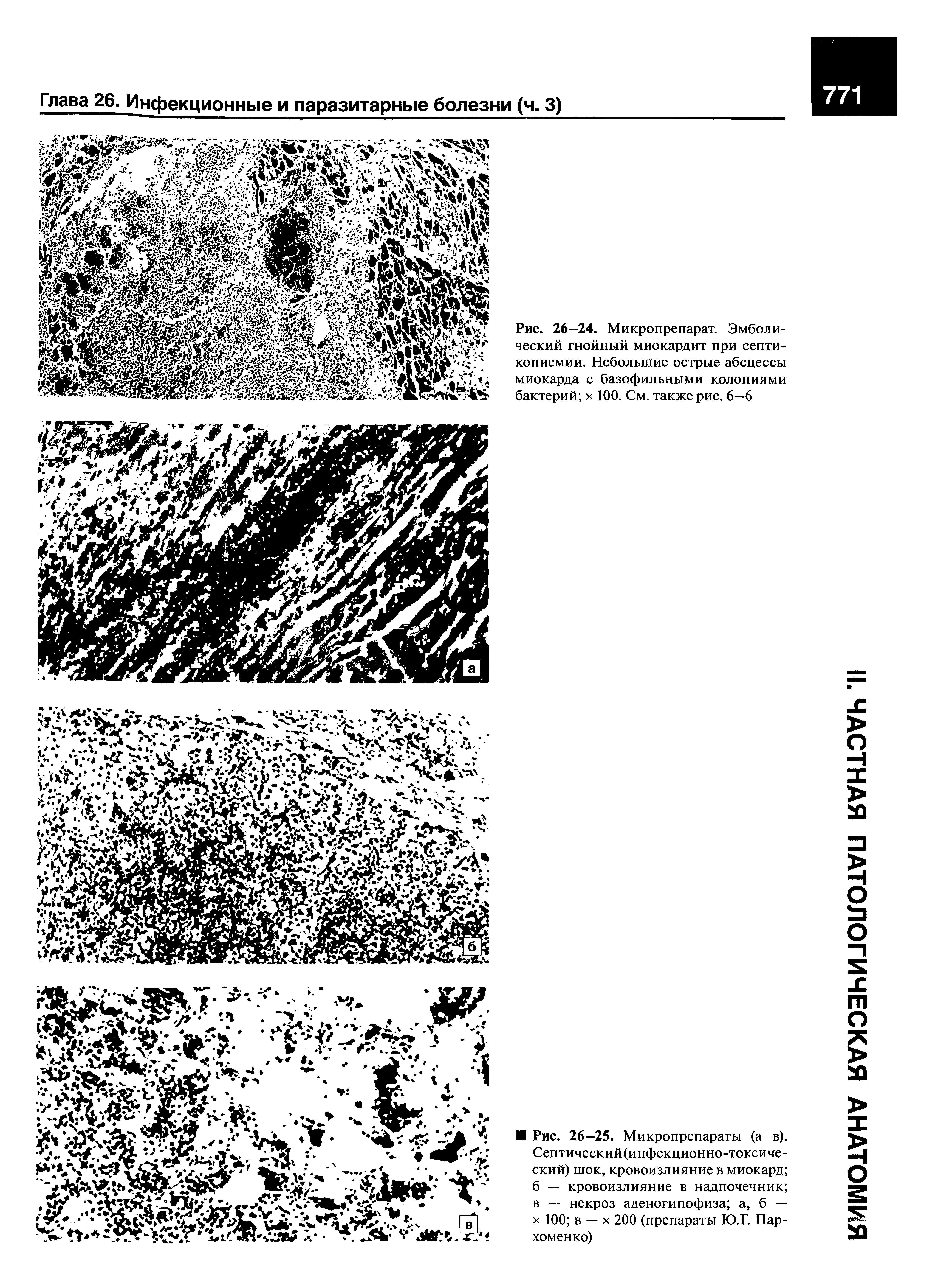 Рис. 26—24. Микропрепарат. Эмболический гнойный миокардит при септи-копиемии. Небольшие острые абсцессы миокарда с базофильными колониями бактерий х 100. См. также рис. 6—6...