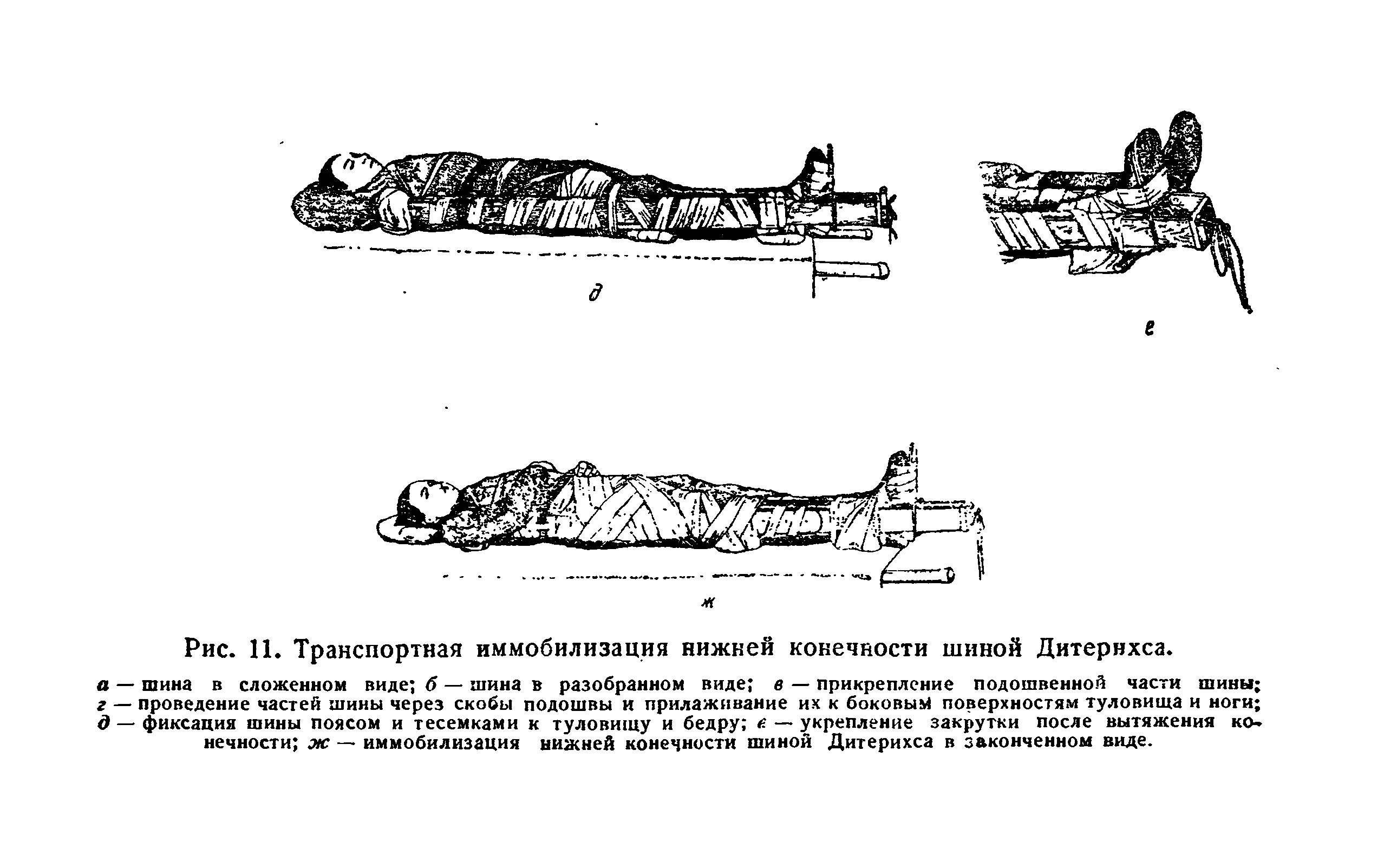 Рис. 11. Транспортная иммобилизация нижней конечности шиной Дитернхса.