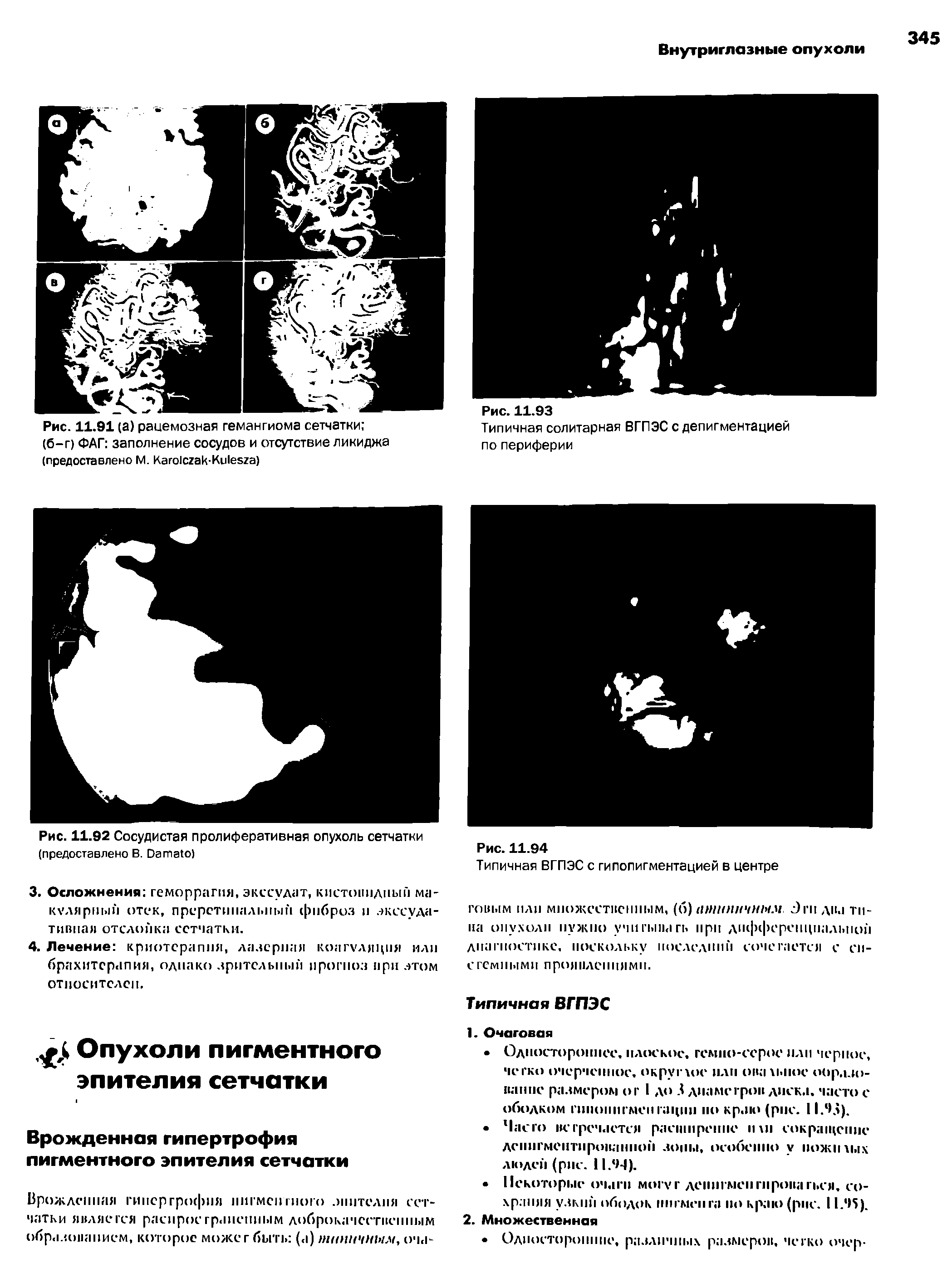 Рис. 11.92 Сосудистая пролиферативная опухоль сетчатки (предоставлено В. D )...