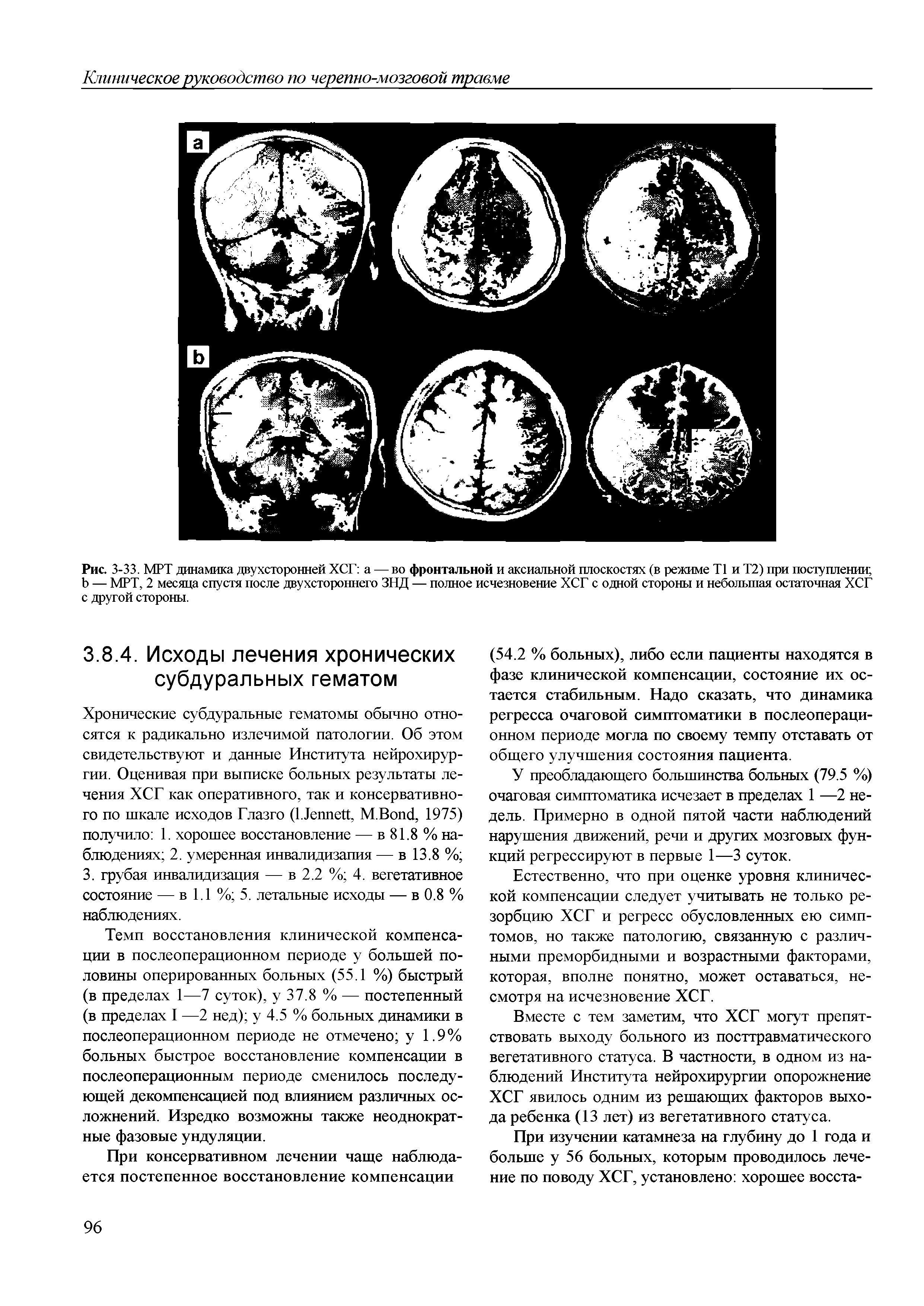 Рис. 3-33. МРТ динамика двухсторонней ХСГ а — во фронтальной и аксиальной плоскостях (в режиме Т1 и Т2) при поступлении — МРТ, 2 месяца спустя после двухстороннего ЗНД — полное исчезновение ХСГ с одной стороны и небольшая остаточная ХСГ с другой стороны.