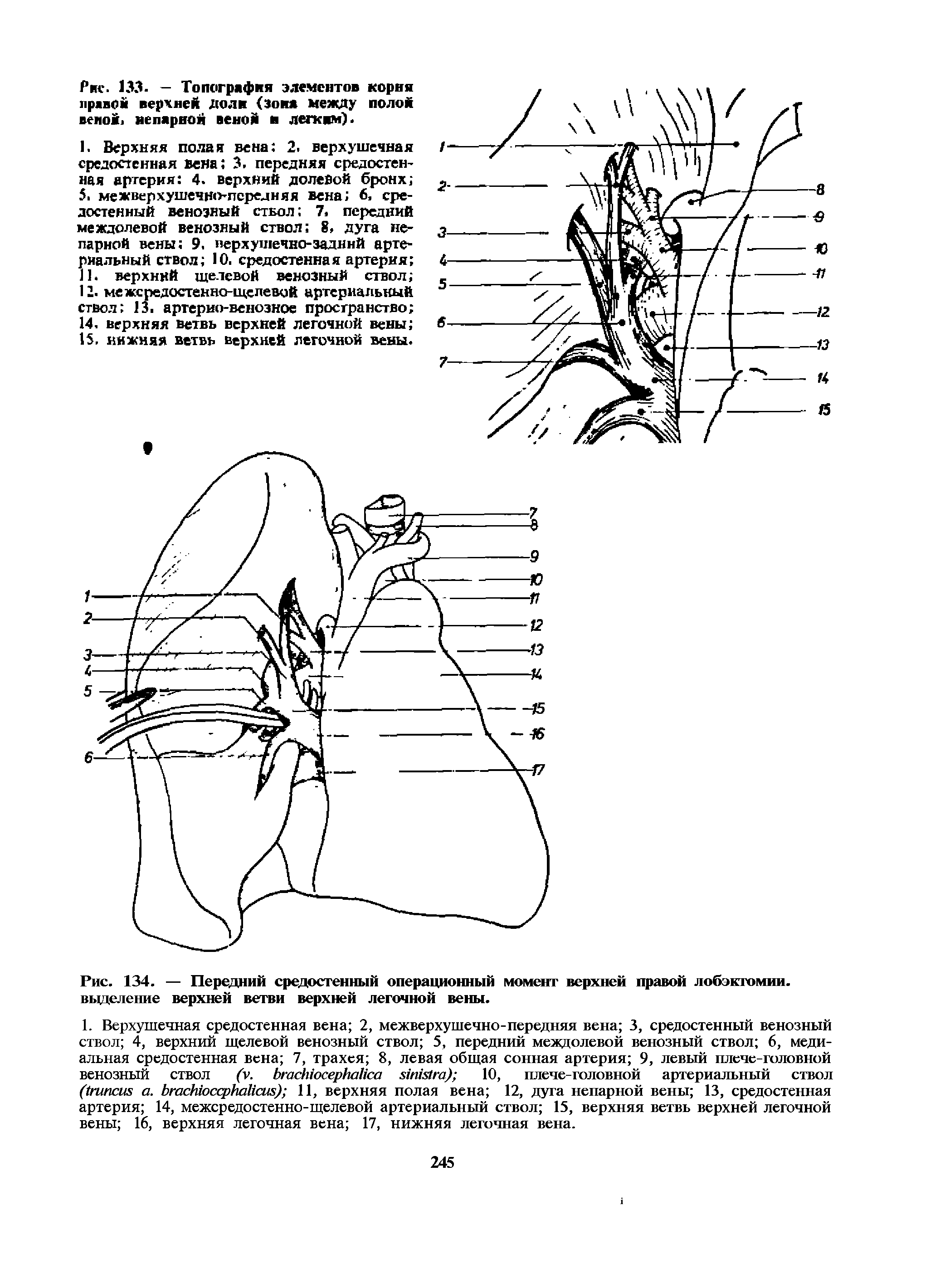 Рис. 134. — Передний средостенный операционный момент верхней правой лобэктомии, выделение верхней ветви верхней легочной вены.