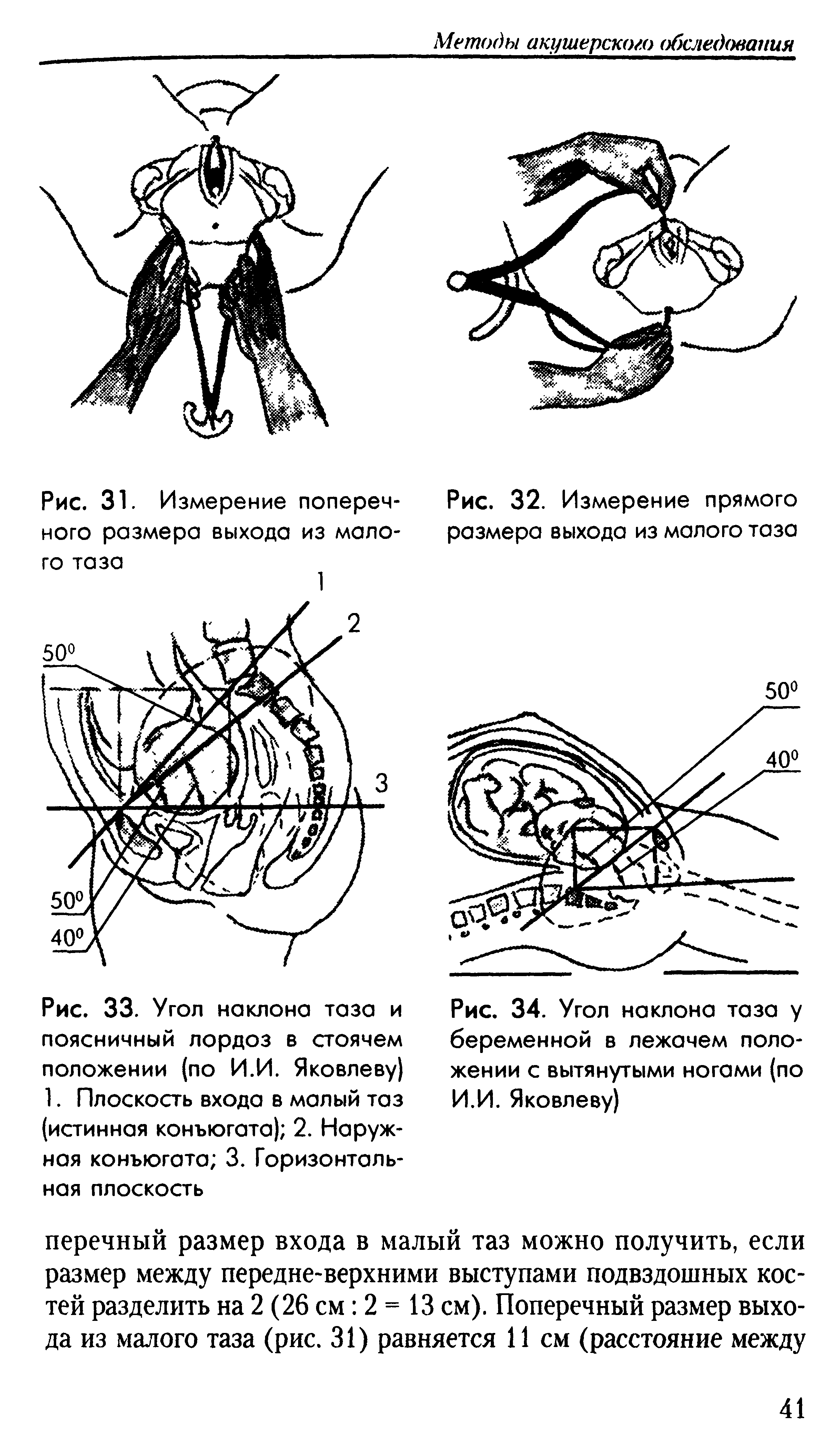 Рис. 32. Измерение прямого размера выхода из малого таза...