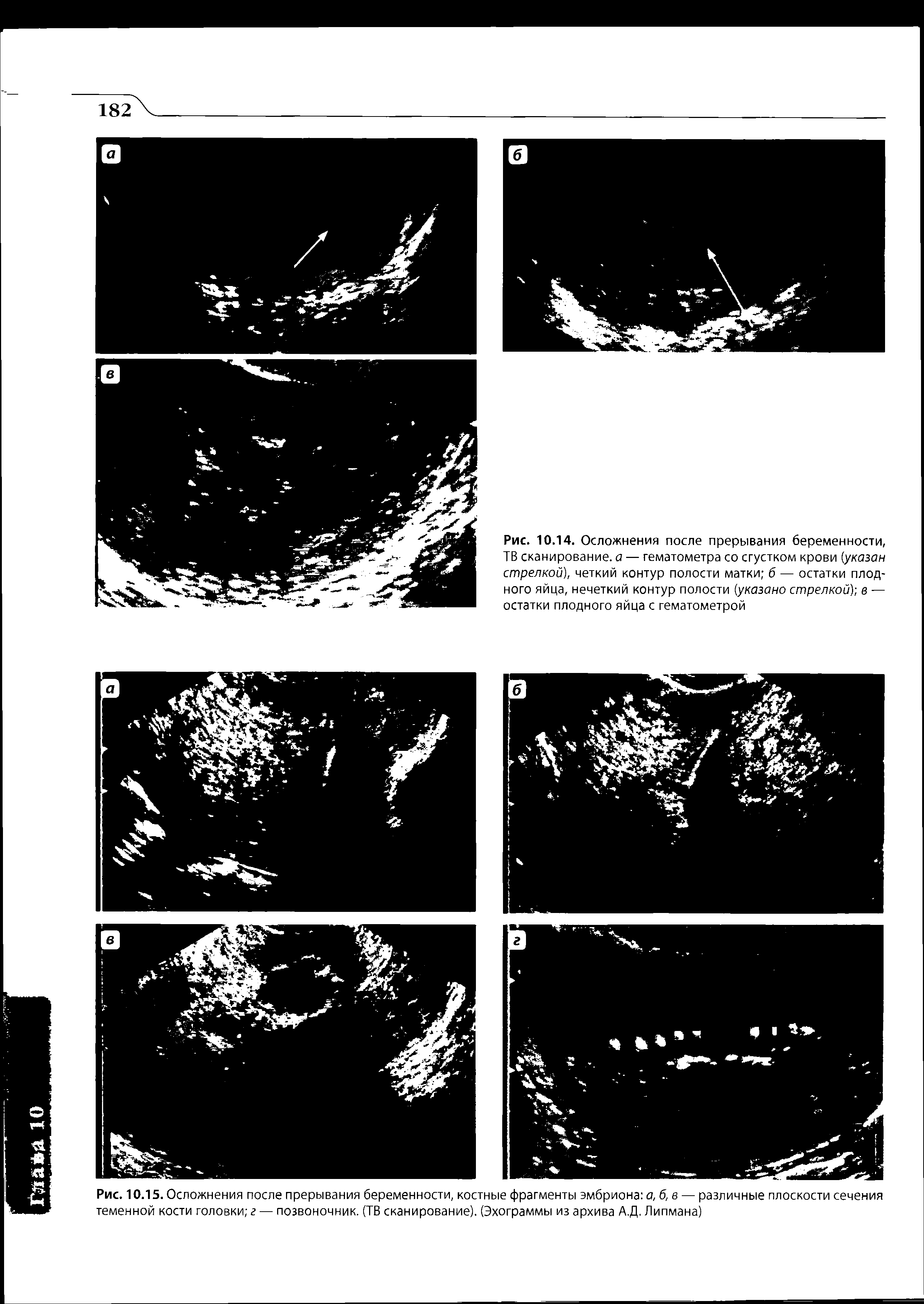 Рис. 10.14. Осложнения после прерывания беременности, ТВ сканирование, а — гематометра со сгустком крови (указан стрелкой), четкий контур полости матки б — остатки плодного яйца, нечеткий контур полости (указано стрелкой) в — остатки плодного яйца с гематометрой...