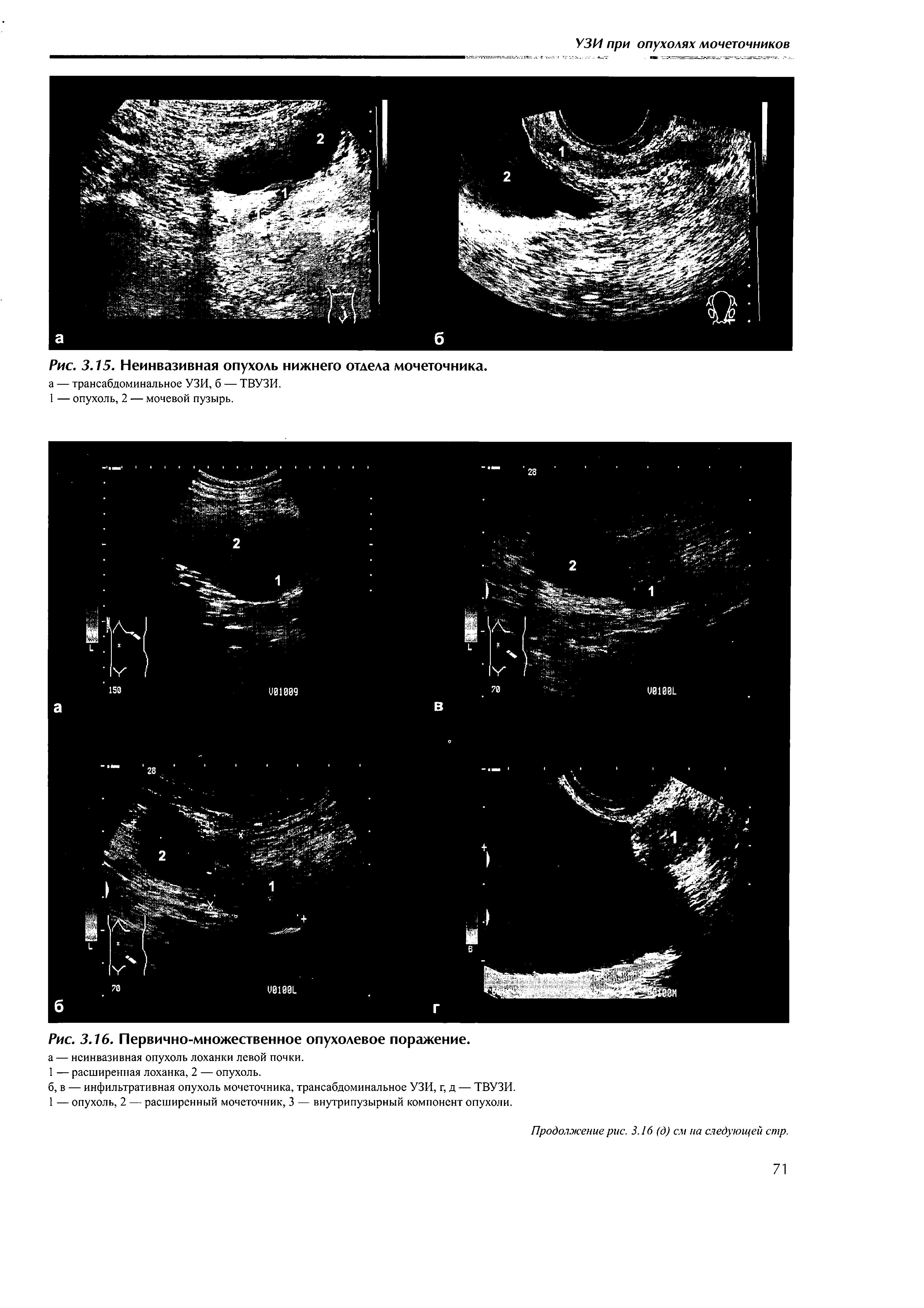 Рис. 3.15. Неинвазивная опухоль нижнего отдела мочеточника, а — трансабдоминальное УЗИ, б — ТВУЗИ.