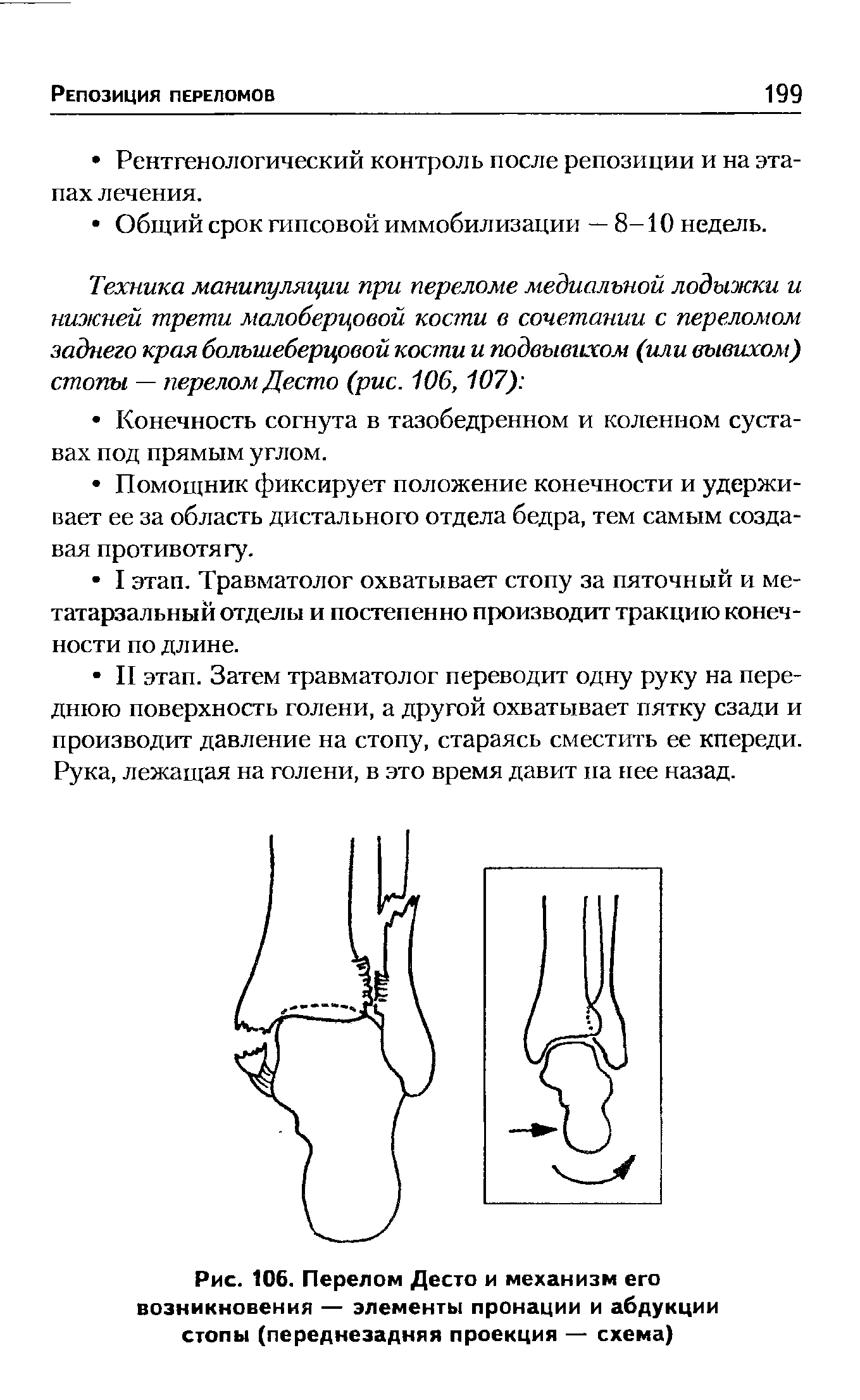 Рис. 106. Перелом Десто и механизм его возникновения — элементы пронации и абдукции стопы (переднезадняя проекция — схема)...