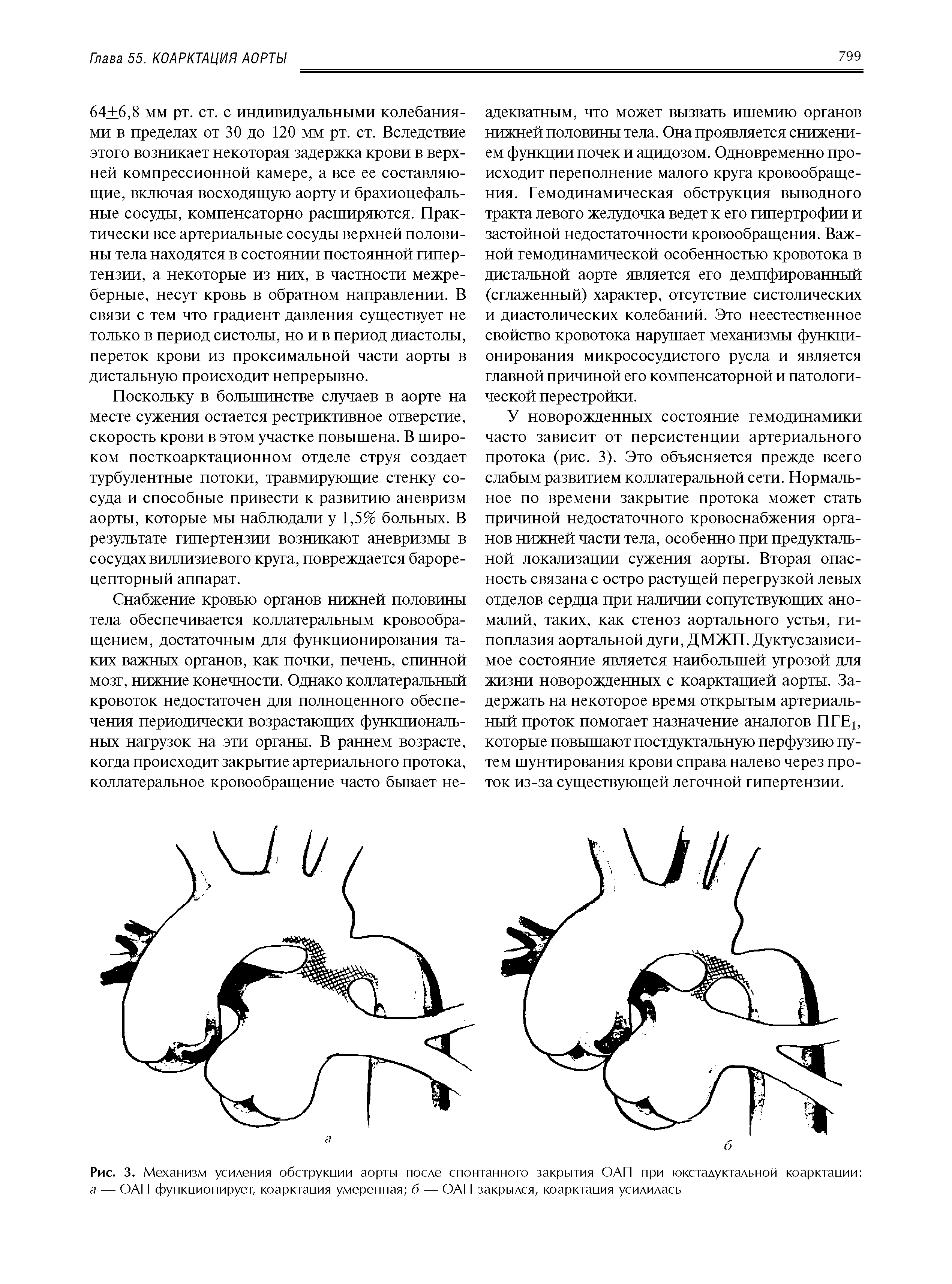 Рис. 3. Механизм усиления обструкции аорты после спонтанного закрытия ОАП при юкстадуктальной коарктации а — ОАП функционирует, коарктация умеренная б — ОАП закрылся, коарктация усилилась...