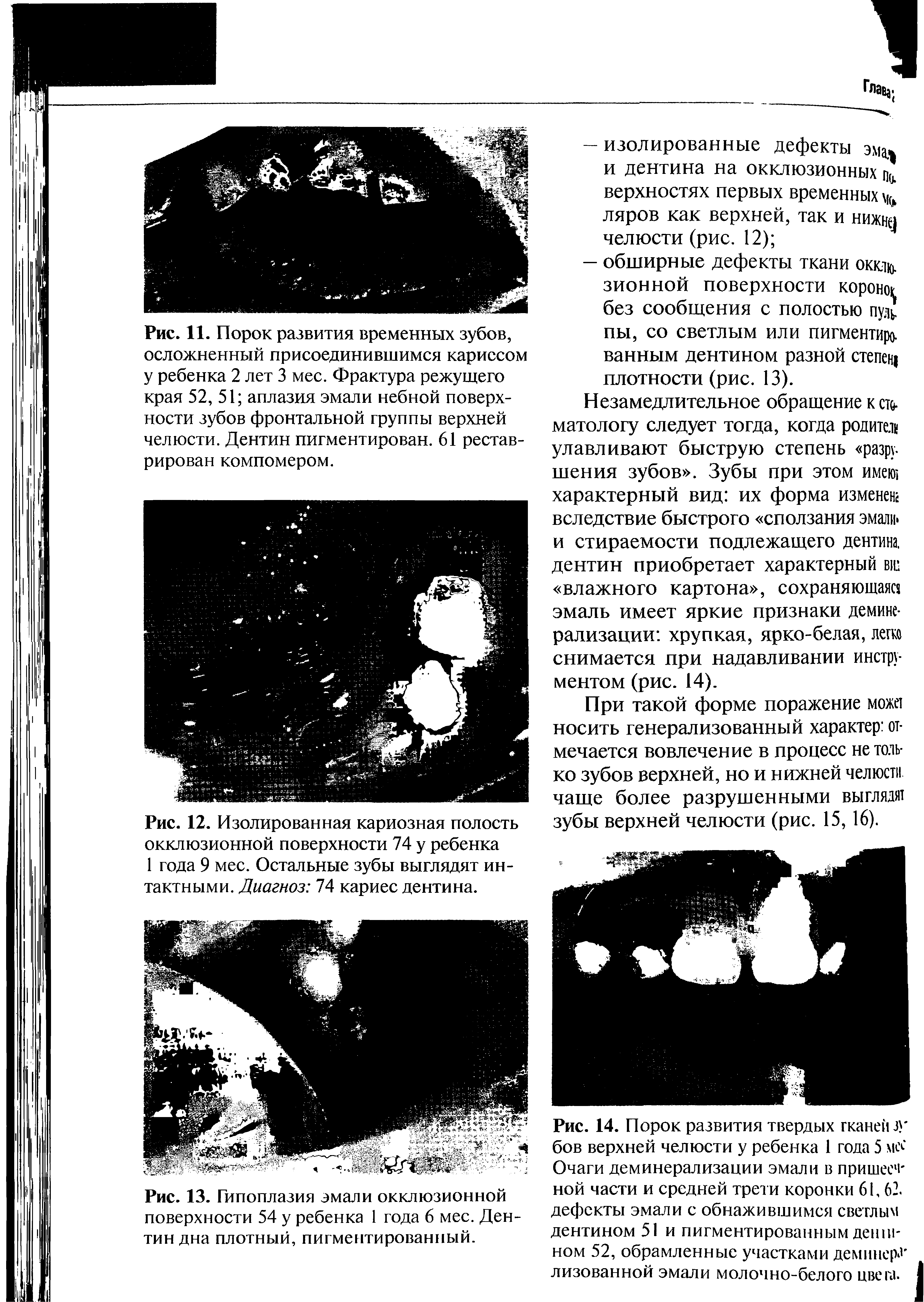 Рис. 12. Изолированная кариозная полость окклюзионной поверхности 74 у ребенка 1 года 9 мес. Остальные зубы выглядят интактными. Диагноз ТА кариес дентина.