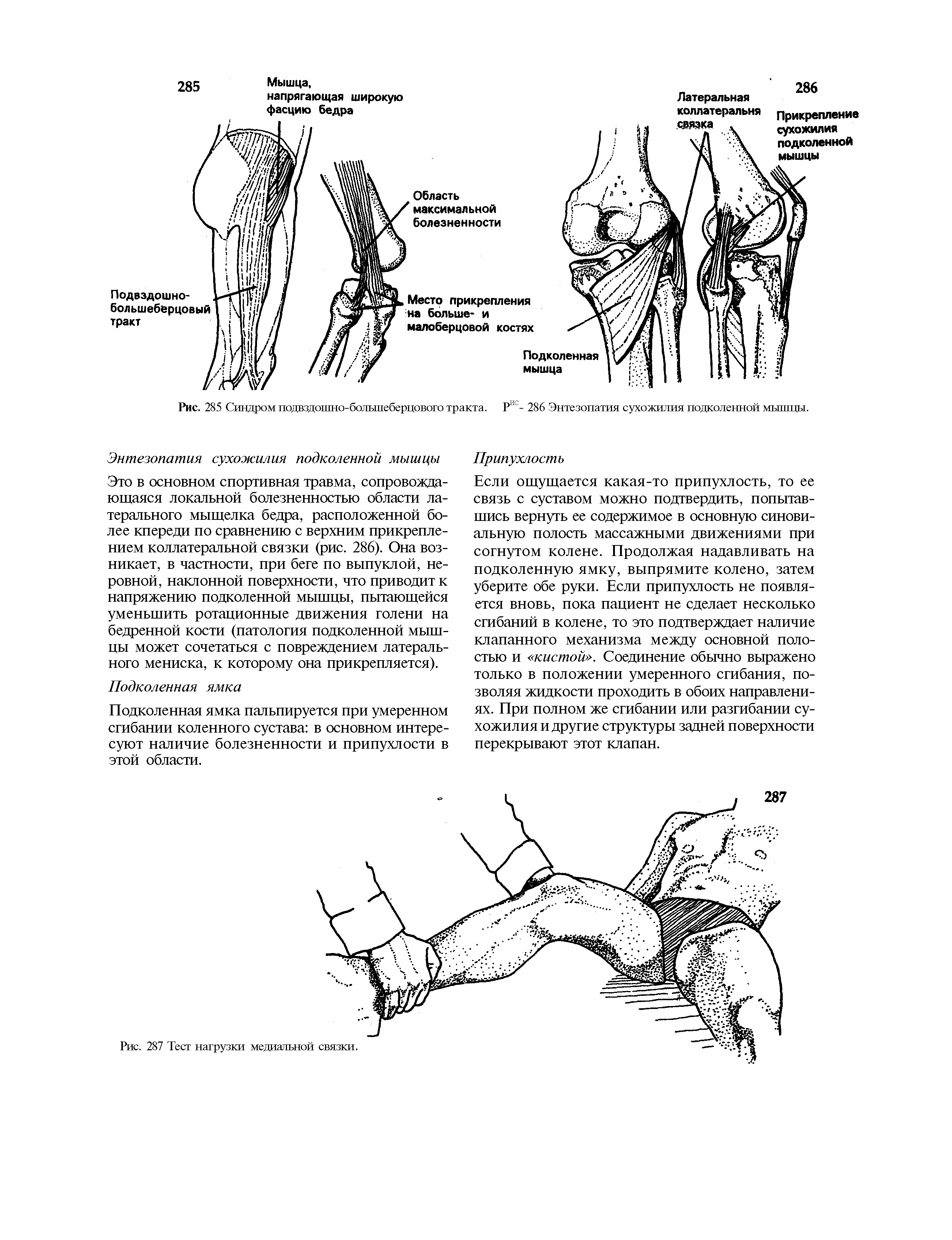 Рис. 285 Синдром подвздошно-большеберцового тракта. Рис- 286 Энтезопатия сухожилия подколенной мышцы.