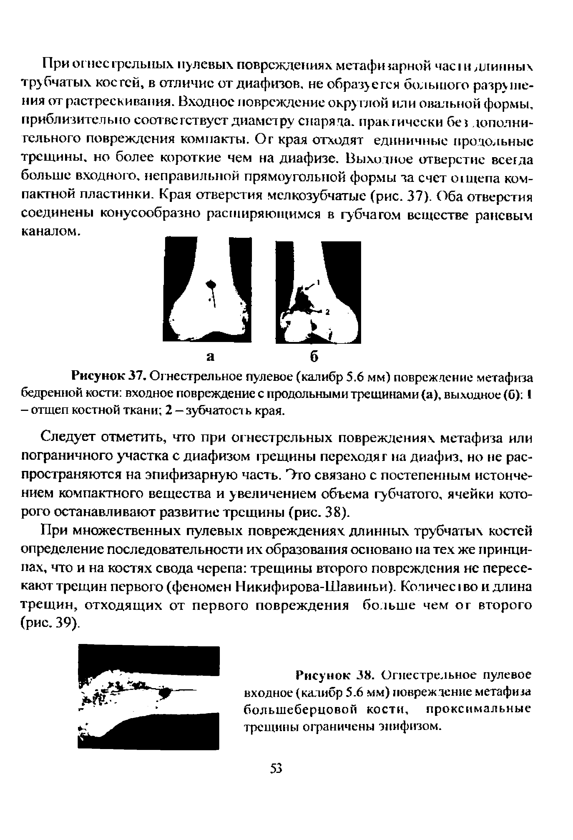 Рисунок 37. Огнестрельное пулевое (калибр 5.6 мм) повреждение метафиза бедренной кости входное повреждение с продольными трещинами (а), выходное (б) 1 - отшеп костной ткани 2 — зубчатост ь края.