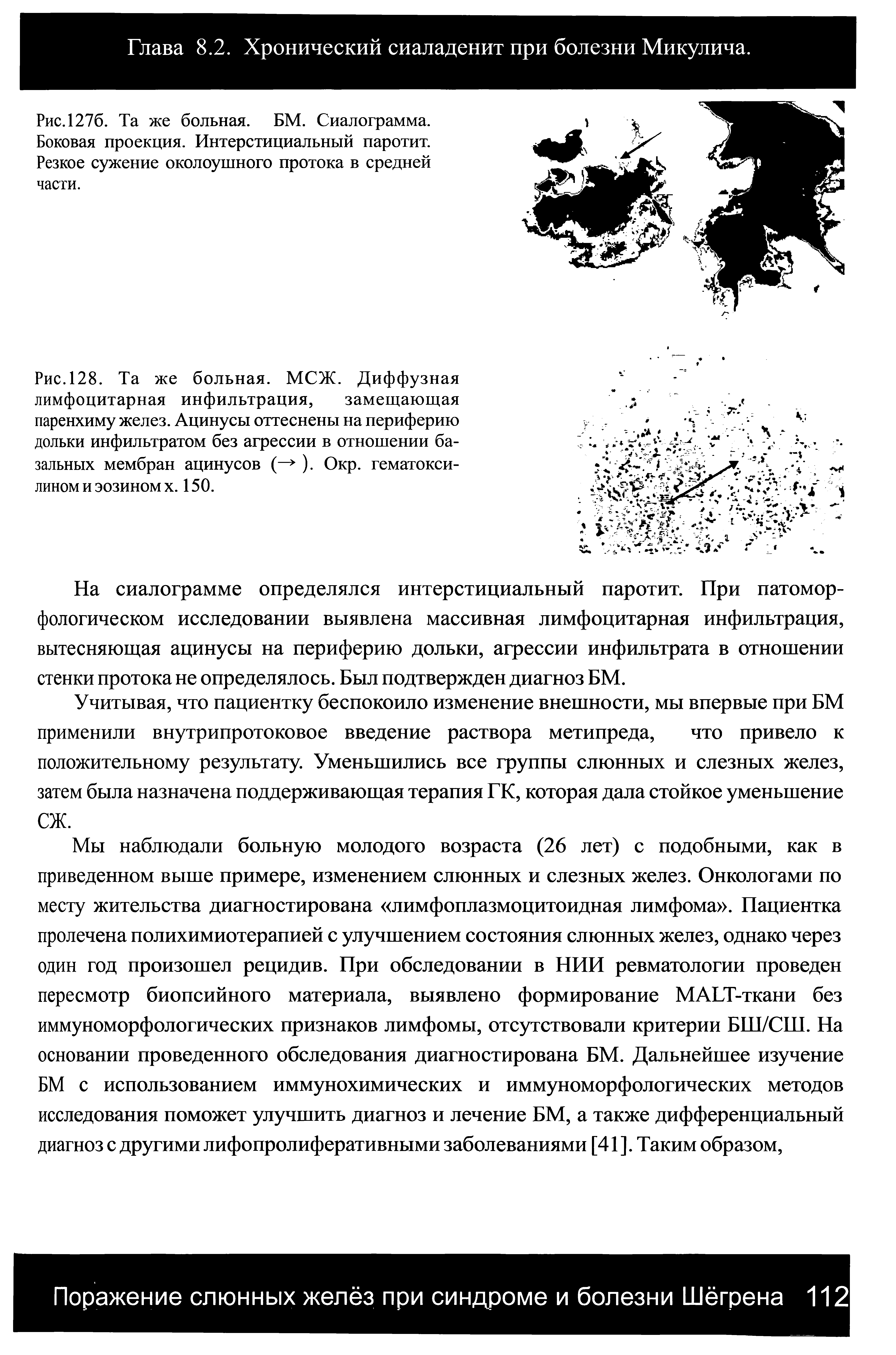 Рис. 1276. Та же больная. БМ. Сиалограмма. Боковая проекция. Интерстициальный паротит. Резкое сужение околоушного протока в средней части.