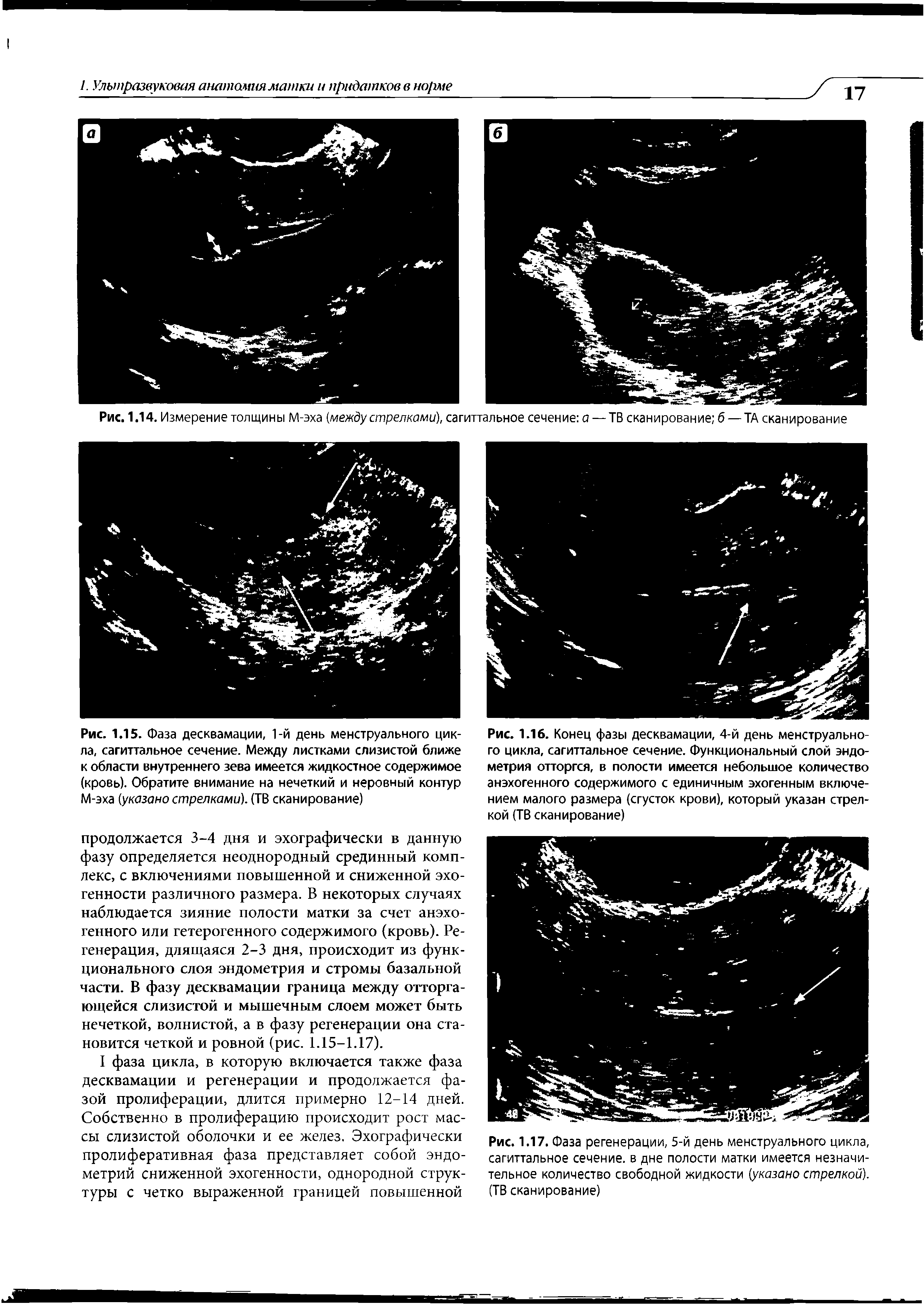 Рис. 1.17. Фаза регенерации, 5-й день менструального цикла, сагиттальное сечение, в дне полости матки имеется незначительное количество свободной жидкости (указано стрелкой). (ТВ сканирование)...