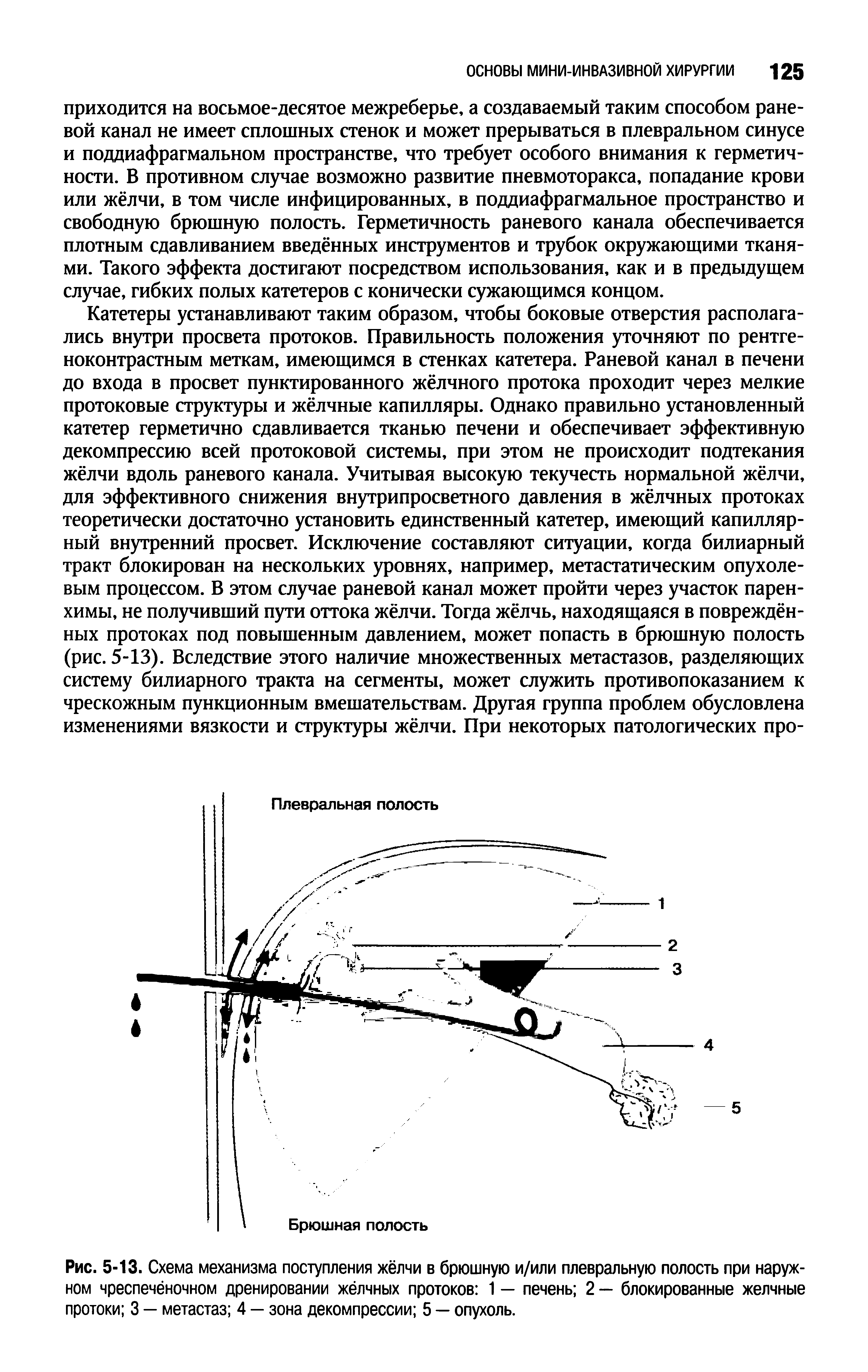 Рис. 5-13. Схема механизма поступления жёлчи в брюшную и/или плевральную полость при наружном чреспечёночном дренировании жёлчных протоков 1 — печень 2 — блокированные желчные протоки 3 — метастаз 4 — зона декомпрессии 5 — опухоль.