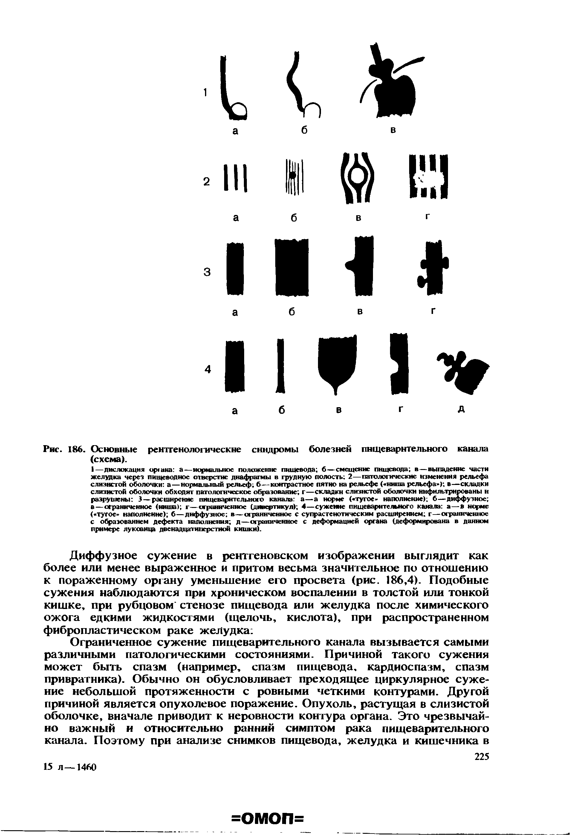 Рис. 186. Основные рентгенологические синдромы болезнен пищеварительного канала (схема).