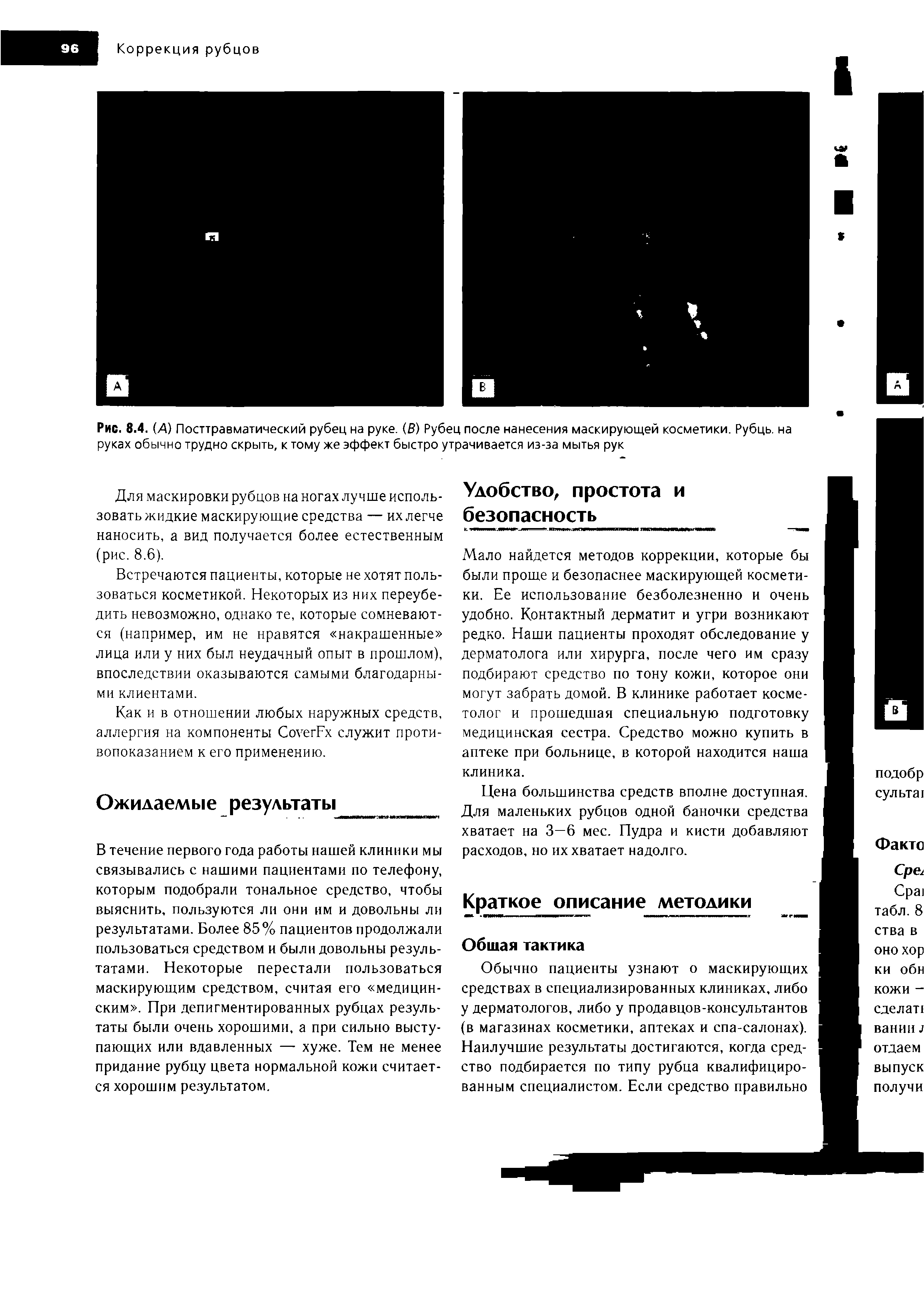 Рис. 8.4. (А) Посттравматический рубец на руке. (В) Рубец после нанесения маскирующей косметики. Рубць. на руках обычно трудно скрыть, к тому же эффект быстро утрачивается из-за мытья рук...