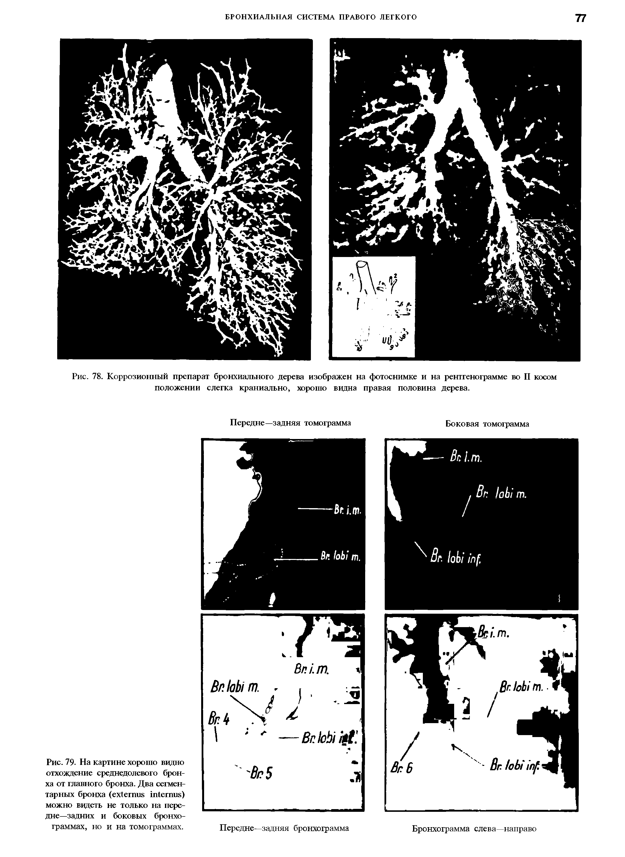 Рис. 78. Коррозионный препарат бронхиального дерева изображен на фотоснимке и на рентгенограмме во II косом положении слегка краниально, хорошо видна правая половина дерева.
