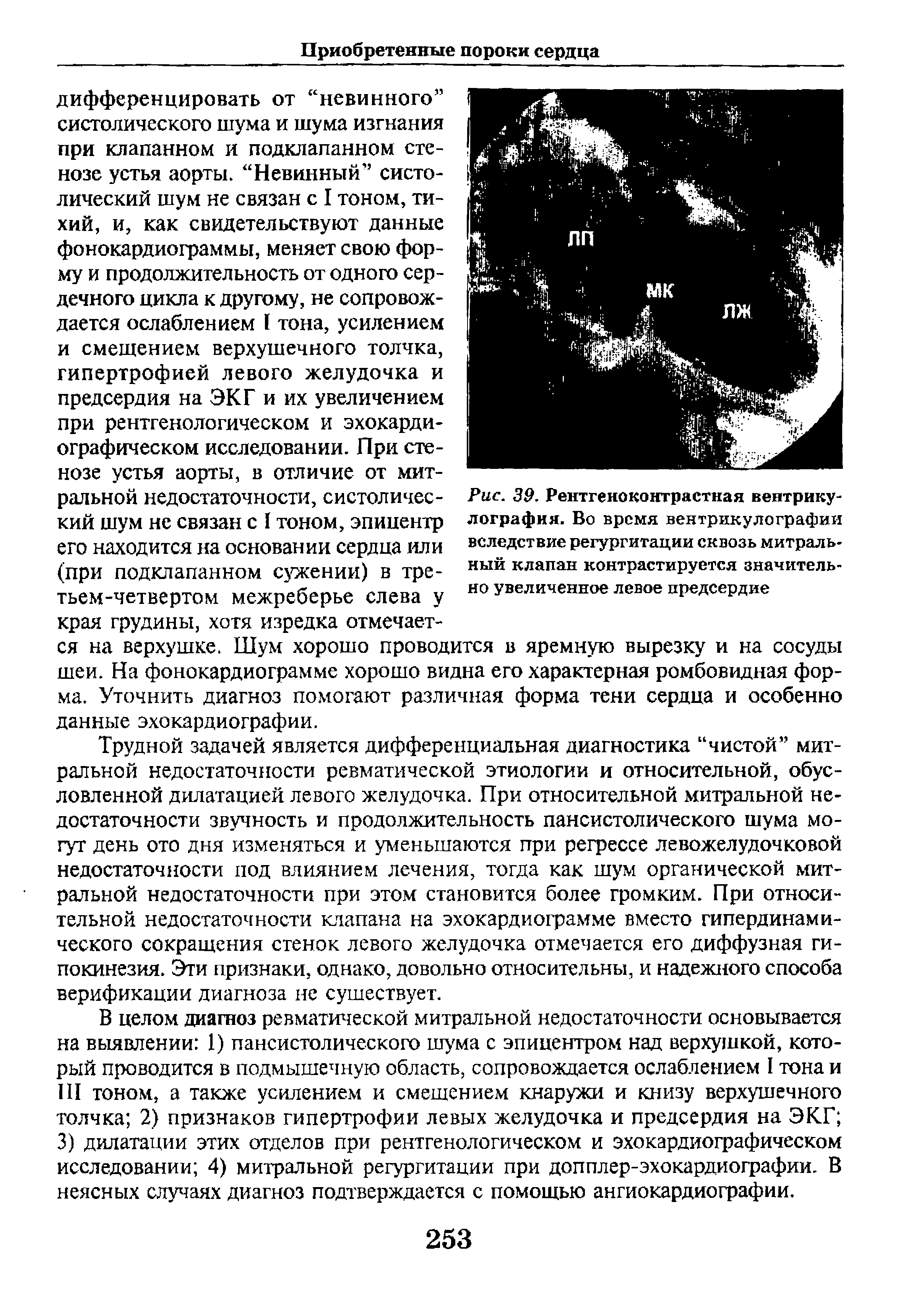 Рис. 39. Рентгеноконтрастная вентрикулография. Во время вентрикулографии вследствие регургитации сквозь митральный клапан контрастируется значительно увеличенное левое предсердие...