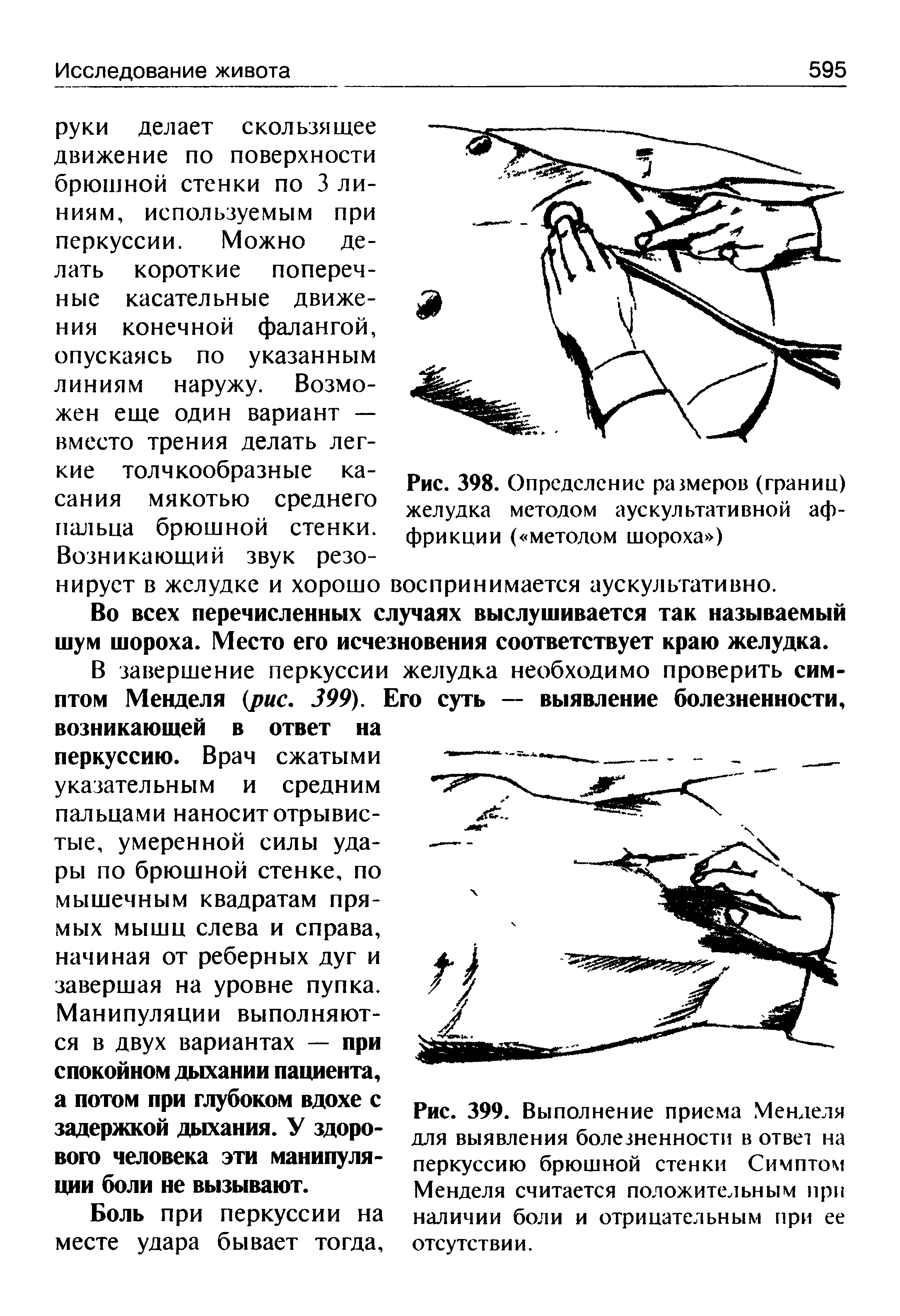 Рис. 399. Выполнение приема Менделя для выявления болезненности в ответ на перкуссию брюшной стенки Симптом Менделя считается положительным при наличии боли и отрицательным при ее отсутствии.