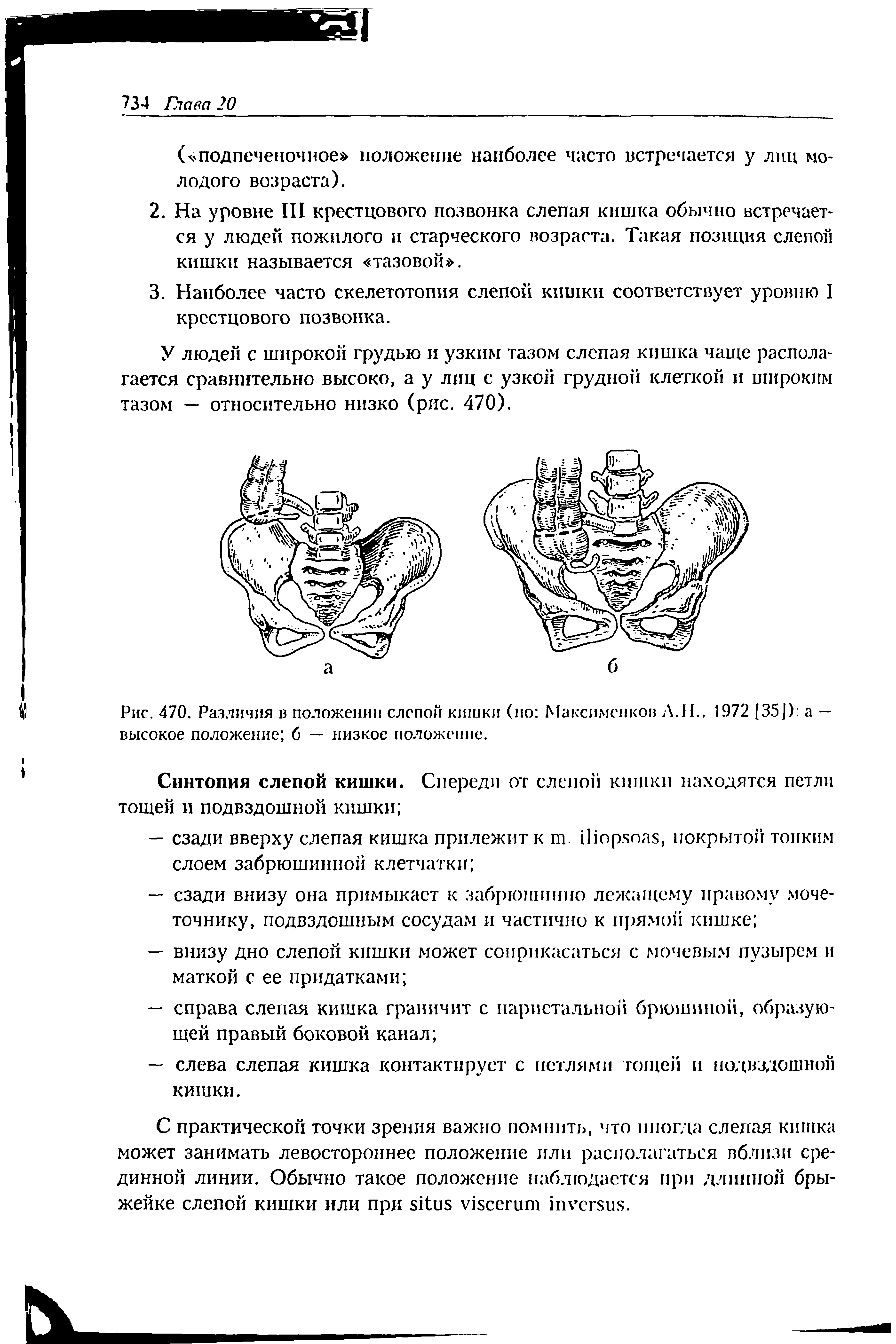 Рис. 470. Различия и положении слепой кишки (ио Максимснков А.Н., 1972 [35]) а — высокое положение б — низкое положение.