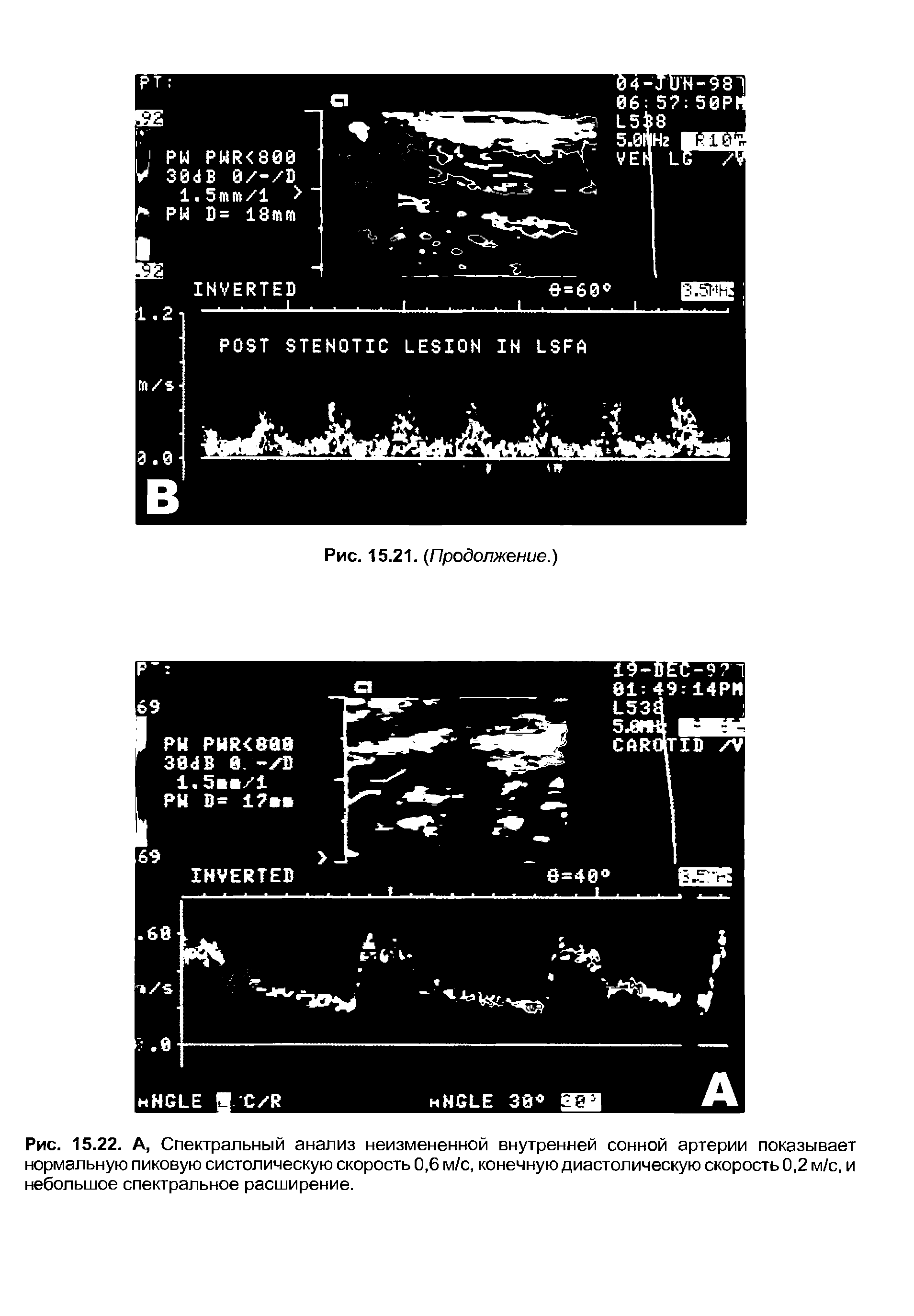 Рис. 15.22. А, Спектральный анализ неизмененной внутренней сонной артерии показывает нормальную пиковую систолическую скорость 0,6 м/с, конечную диастолическую скорость 0,2 м/с, и небольшое спектральное расширение.