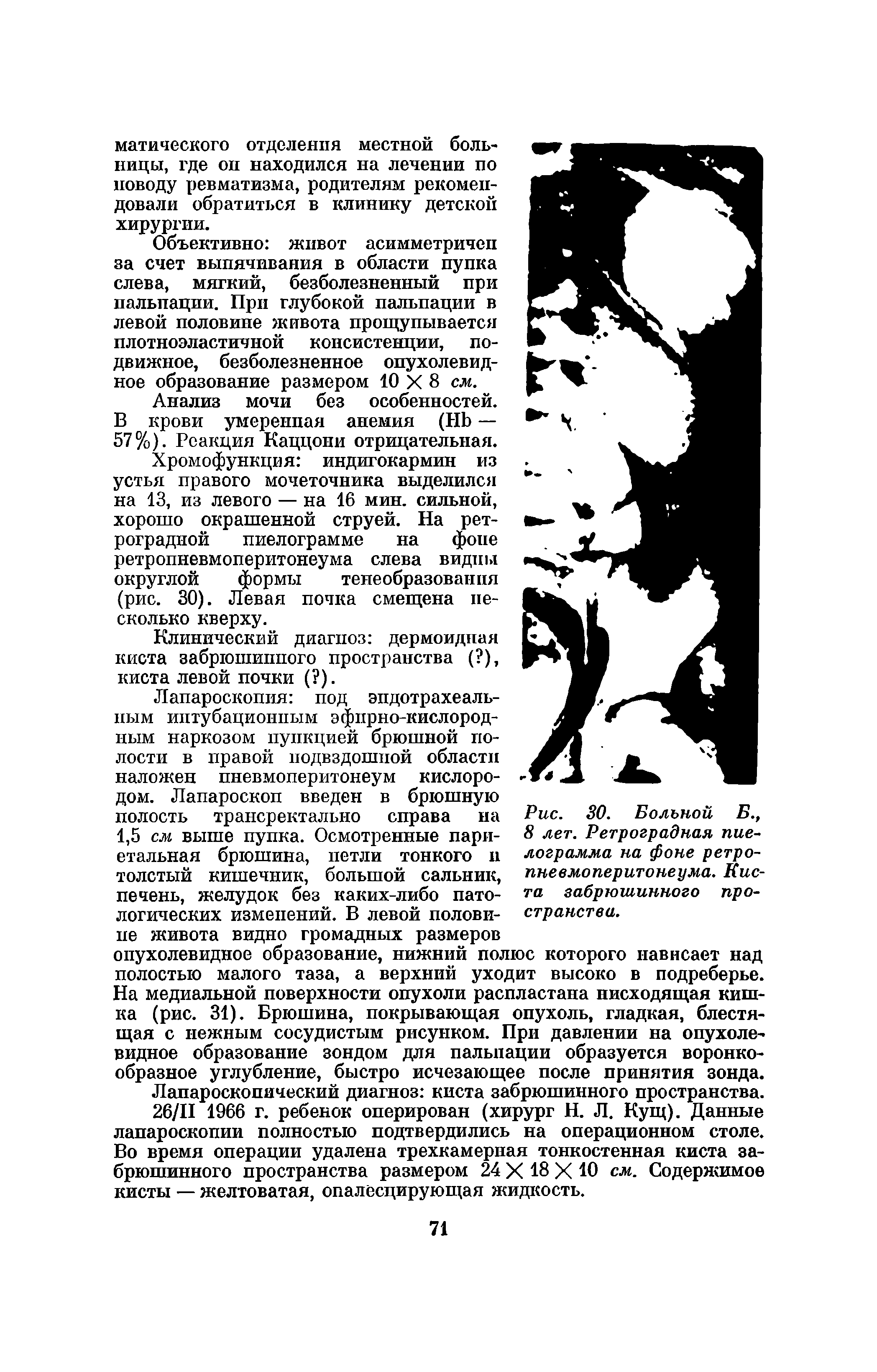 Рис. 30. Вольной В., 8 лет. Ретроградная пиелограмма на фоне ретропневмоперитонеума. Киста забрюшинного пространства.