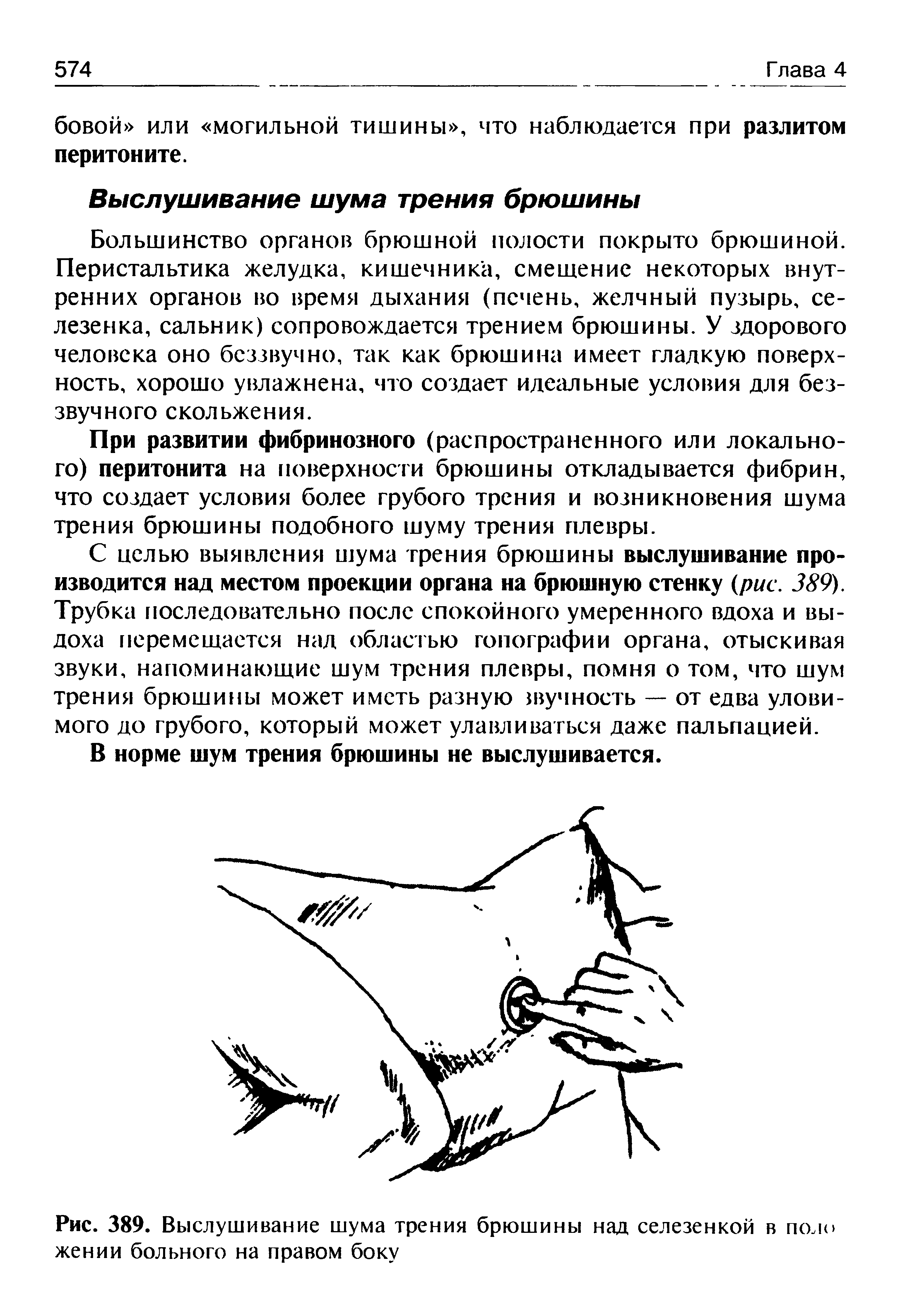 Рис. 389. Выслушивание шума трения брюшины над селезенкой в поло жении больного на правом боку...