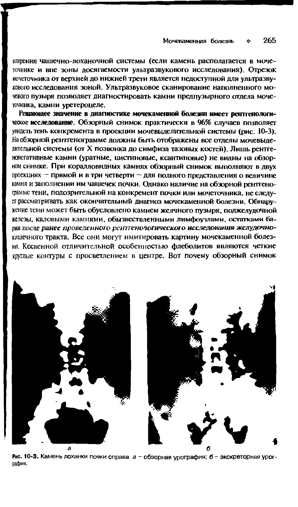 Рис. 10-3. Камень лоханки почки справа а - обзорная урография б - экскреторная урография.