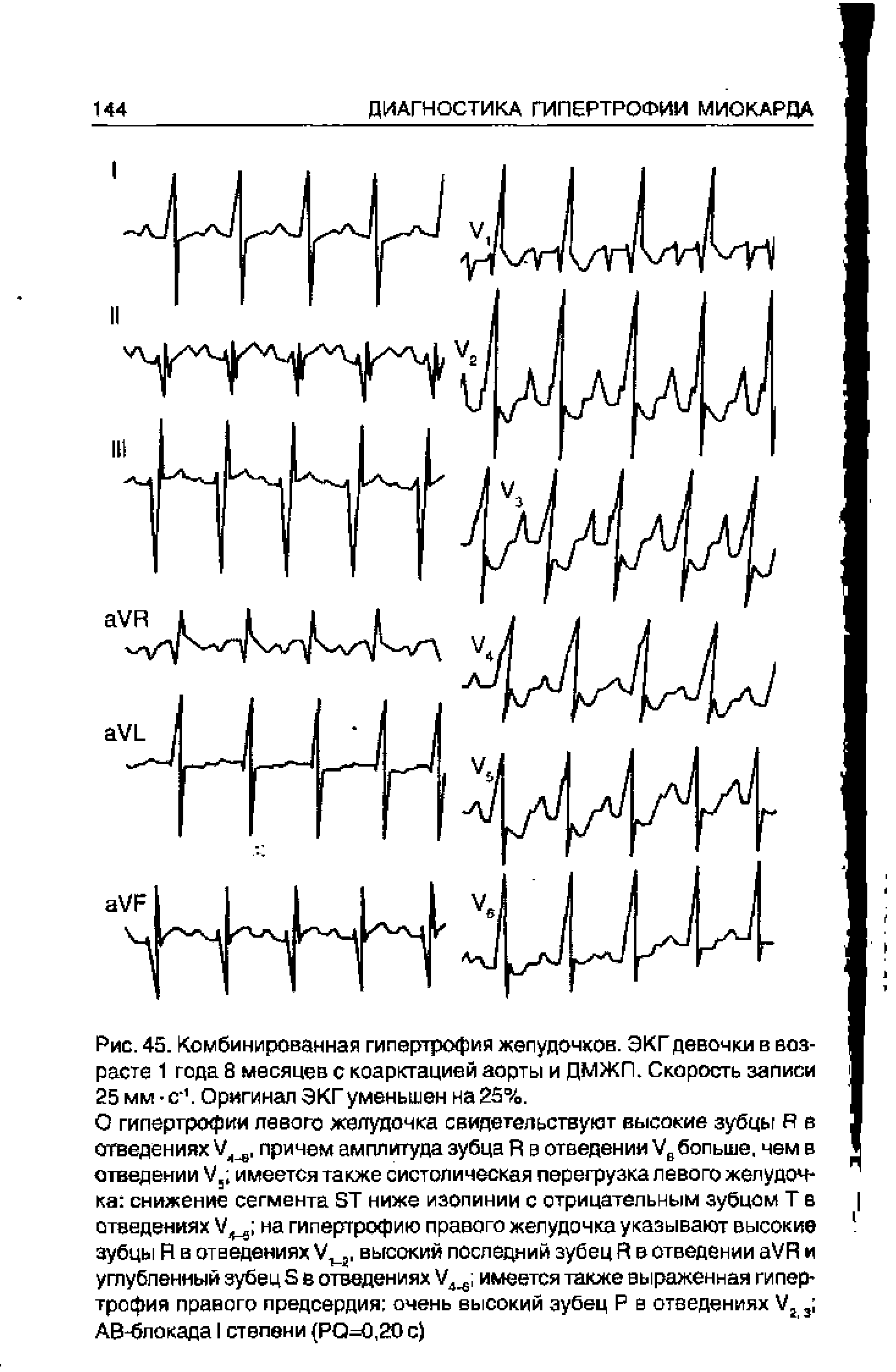 Рис. 45. Комбинированная гипертрофия желудочков. ЭКГ девочки в возрасте 1 года 8 месяцев с коарктацией аорты и ДМЖП. Скорость записи 25 мм - с 1. Оригинал ЭКГ уменьшен на 25%.