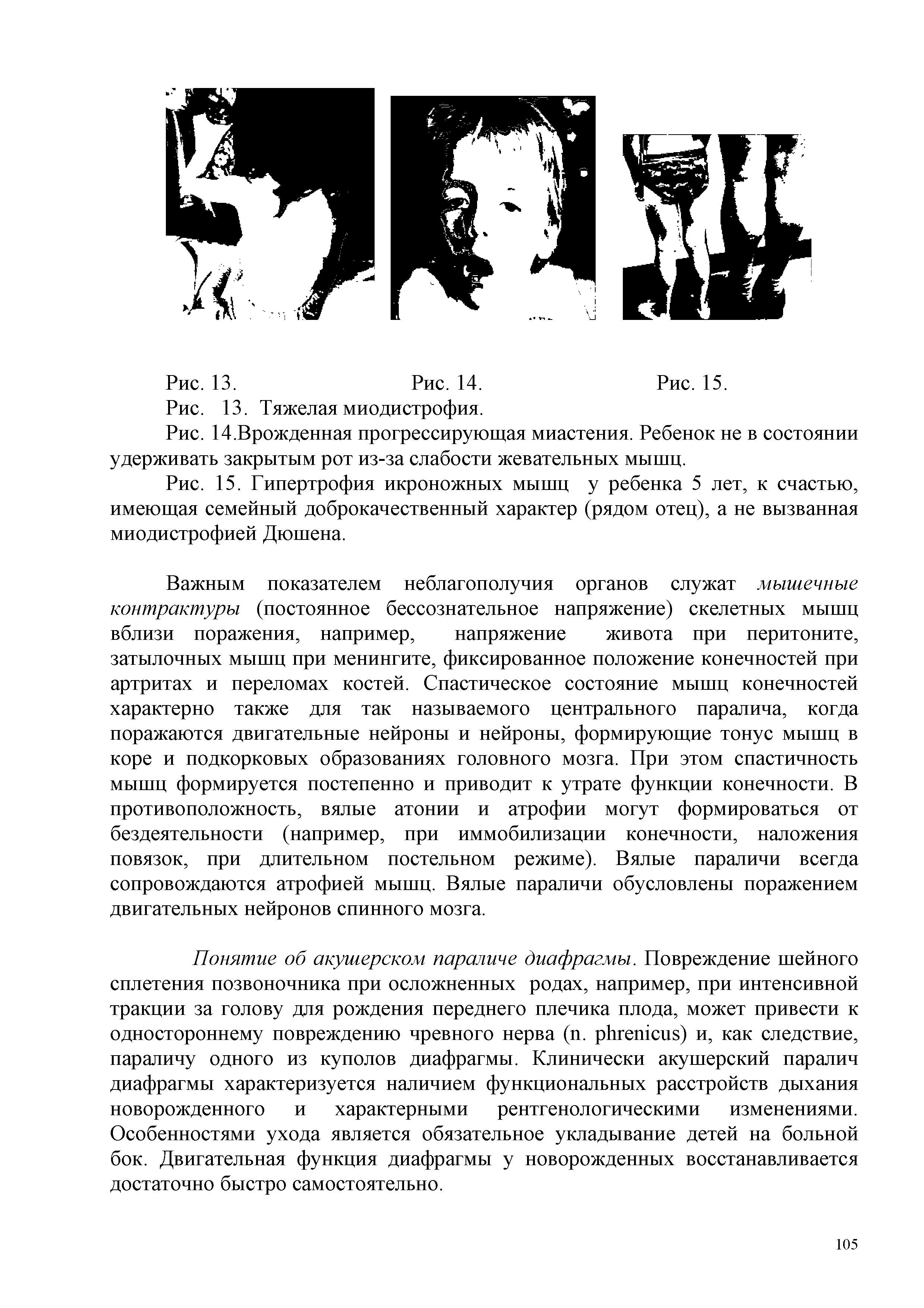 Рис. 15. Гипертрофия икроножных мышц у ребенка 5 лет, к счастью, имеющая семейный доброкачественный характер (рядом отец), а не вызванная миодистрофией Дюшена.