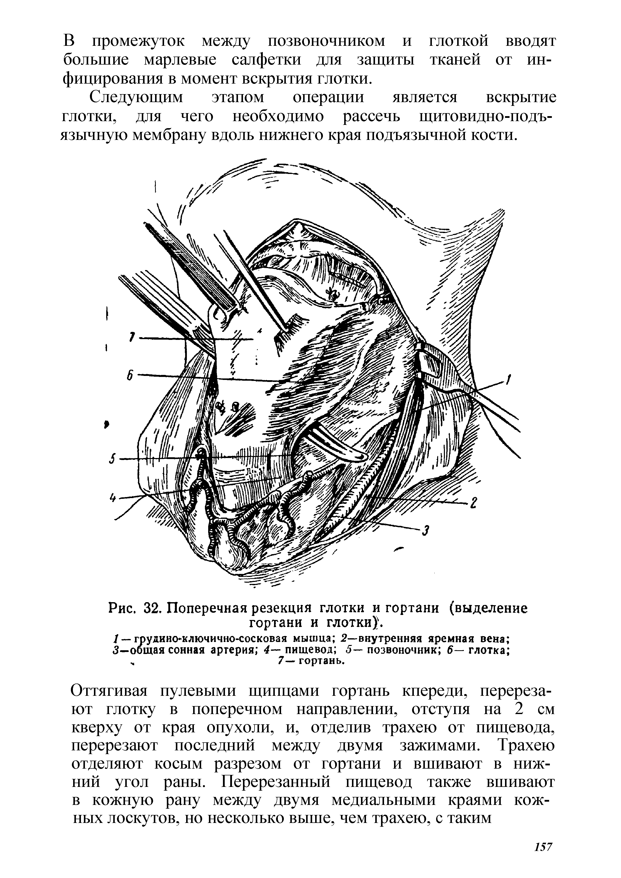 Рис. 32. Поперечная резекция глотки и гортани (выделение гортани и глотки). ...