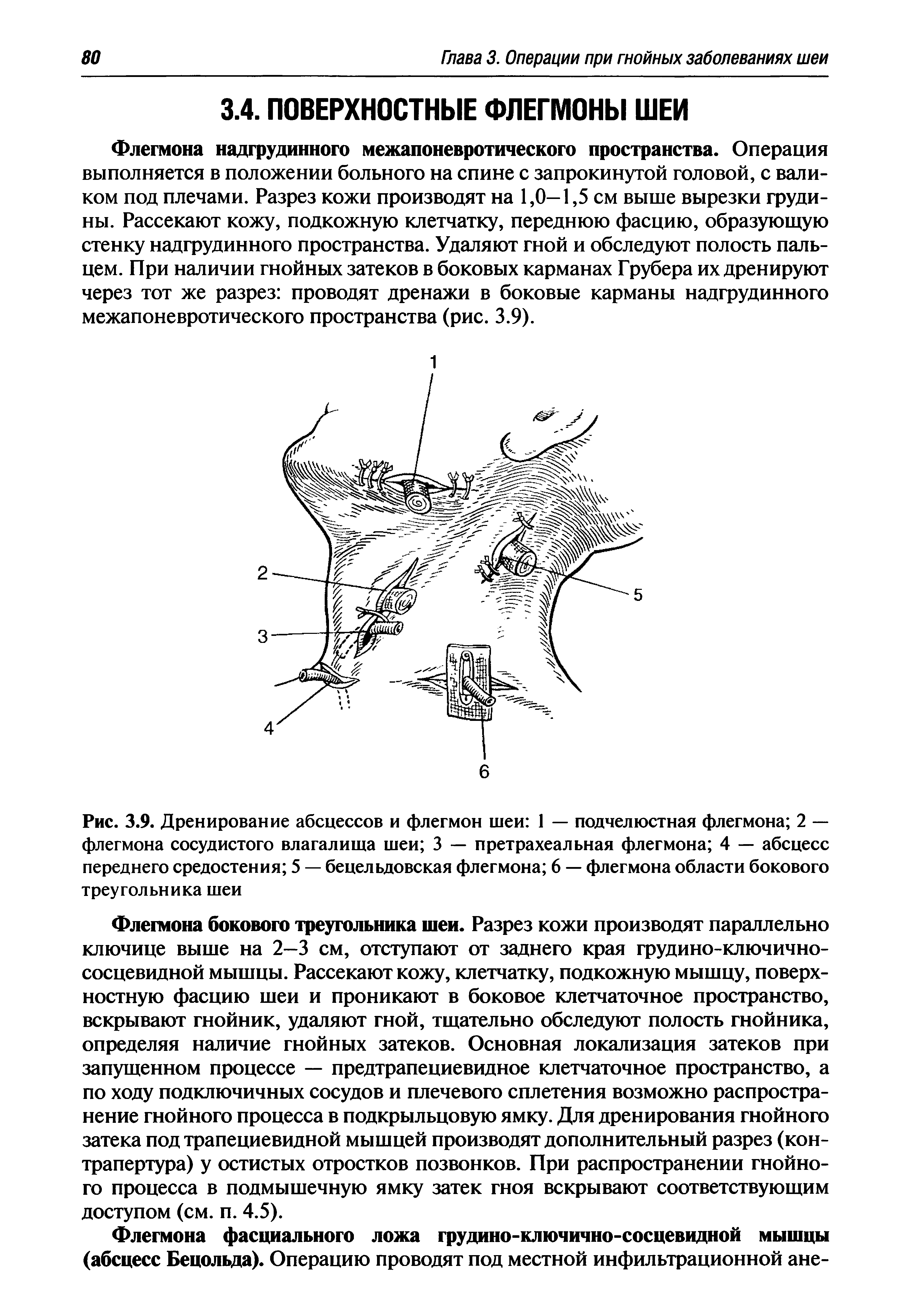 Рис. 3.9. Дренирование абсцессов и флегмон шеи 1 — подчелюстная флегмона 2 — флегмона сосудистого влагалища шеи 3 — претрахеальная флегмона 4 — абсцесс переднего средостения 5 — бецельдовская флегмона 6 — флегмона области бокового треугольника шеи...