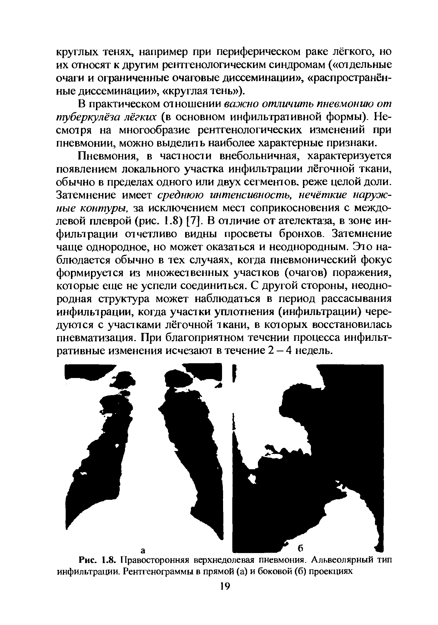 Рис. 1.8. Правосторонняя верхнедолевая пневмония. Альвеолярный тип инфильтрации. Рентгенограммы в прямой (а) и боковой (б) проекциях...